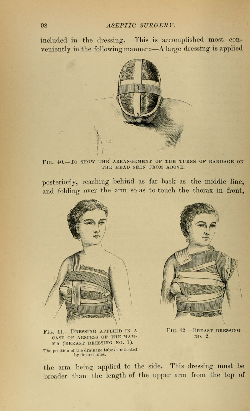 included in the dressing. This is accomplished most con- veniently in the following manner:—A large dressing is applied FICt. 40.—To SHOW THE ARRANGEMENT OF THE TURNS OP BANDAGE ON THE HEAD SEEN FROM ABOVE. posteriorly, reaching behind as far back as the middle line, and folding over the arm so as to touch the thorax in front, Fig. 41.—Dressing applied in a case of abscess of the mam- MA (BREAST DRESSING NO. 1). The position of tlip drainage tube is indicated by dotted lines. Fig. 42.—]5reast dressing- no. 2. the arm being applied to the side. This dressing must be broader than the length of the upper arm from the top of