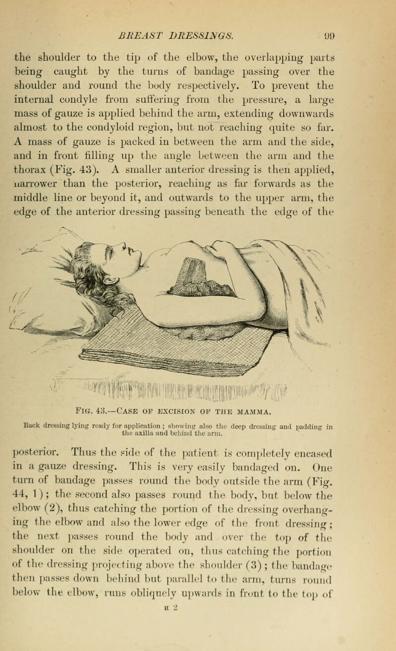 the shoulder to the tip t)f the elbow, the overlapping parts being caught by the turns of bandage passing over the shoulder and round the body respectively. To prevent the internal condyle from suffering from the pressure, a large mass of gauze is applied behind the arm, extending downwards almost to the condyloid region, but not reaching quite so far. A mass of gauze is packed in between the arm and the side, and in front filling up the angle between the arm and the thorax (Fig. 43). A smaller anterior dressing is then applied, narrower than the posterior, reaching as far forwards as the middle line or beyond it, and outwards to the upper arm, the edge of the anterior dressing passing beneath the edge of the Fig. 43.—Case op excision of the mamma. Back dressing lying ready for application ; sliowing also the deep di-cssiug and padding in the axilla and beljind the arm. ])Osterior. Thus the side of the patient is completely encased in a gauze dressing. This is very easily bandaged on. One turn of bandage passes round tlie body outside the arm (Fig. 44, 1); the second also passes round the body, but below the elbow (2), thus catching the portion of the dressing overhang- ing the elbow and also the lower edge of the front dressing ; the next passes roimd the body and over the top of the shoulder on the side operated on, thus catching tlie portion of the dressing projecting above the shoulder (3) ; tlu; bandao-c then passes down beliind but parallel to tlie arm, turns round below the elbow, runs obliquely upwards in front to the top of