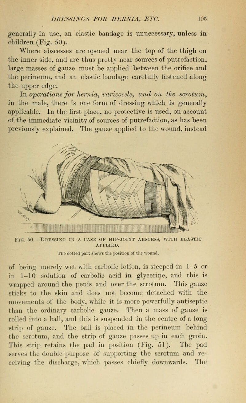 I)Iii:SSINGS FOE HERNIA, ETC. ]05 generally in use, an elastic bandage is unnecessary, unless in children (Fig. 50). Where abscesses are opened near the top of the thigh on the inner side, and are thus pretty near sources of putrefaction, large masses of gauze must be applied between the orifice and the perineum, and an elastic bandage carefully fastened along the upper edge. In operations for hernia^ varicocele, and on the scrotum, in the male, there is one form of dressing which is generally applicable. In the first place, no protective is used, on account of the immediate vicinity of sources of putrefaction, as has been previously explained. The gauze applied to the wound, instead Fir. 50.—Dressing in a cask op hip-joint abscess, with elastic APPLIED. The dotted part sliows tlie position of tlie wound. of being merely wet with carbolic lotion, is steeped in 1-5 or in 1-10 solution of carbolic acid in glycerine, and this is wrapped around the penis and over the scrotum. This gauze sticks to the skin and does not become detached with the movements of the body, while it is more powerfully antiseptic than the ordinary carbolic gauze. Then a mass of gauze is rolled into a ball, and this is suspended in the centre of a long strip of gauze. The ball is i)laced in the jjerineum behind the scrotum, and the strip of gauze passes u}) in each groin. This strip retains the pad in position (Fig. 51). The pad serves the double purpose of supporting the scrotum and re- ceiving the discharge, which passes chiefly downwards. The