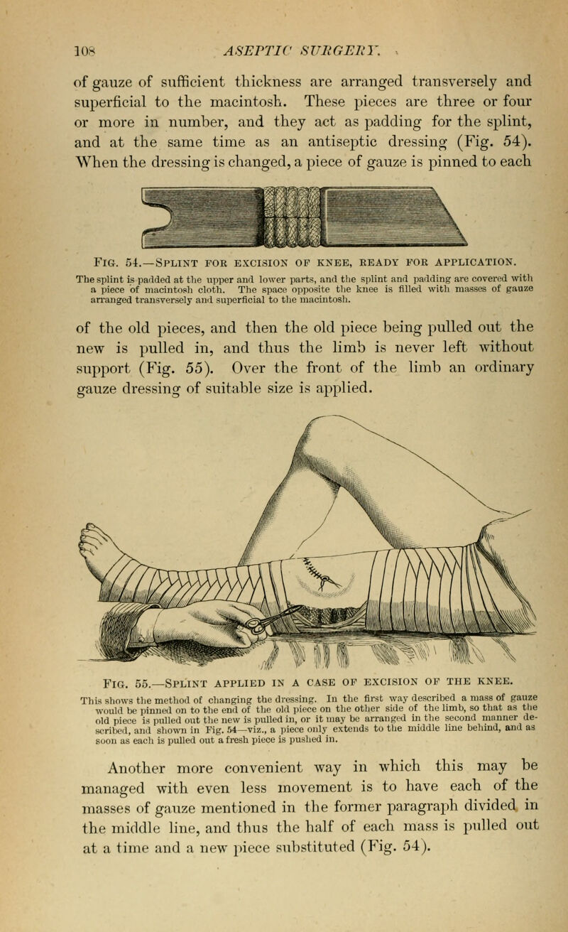 10.H ASEPTIC SlTIiGEliY of gauze of sufficient thickness are arranged transversely and superficial to the macintosh. These pieces are three or four or more in number, and they act as padding for the splint, and at the same time as an antiseptic dressing (Fig. 54). When the dressing is changed, a piece of gauze is pinned to each Fig. 5i.—Splint for excision of knee, ready for application. The splint is padded at the upper and lower parts, and tlie splint and padding are covered with a piece of macintosh cloth. The space opposite the knee is filled with masses of gauze arranged transversely and superficial to the macintosh. of the old pieces, and then the old piece being pulled out the new is pulled in, and thus the limb is never left without support (Fig. 55). Over the front of the limb an ordinary gauze dressing of suitable size is applied. Splint applied in a case op excision op the knee. This shows the method of changing the dressing. In the first way described a mass of gauze would be pinned on to the end of the old piece on the other side of the limb, so that as the old piece is pulled out the new is pulled in, or it may be arranged in the second manner de- sc^ribed, and shown in Fig. 54—viz., a piece only extends to the middle line behind, and as soon as each is pulled out afresh piece is pushed in. Another more convenient way in which this may be managed with even less movement is to have each of the masses of gauze mentioned in the former paragraph divided, in the middle line, and thus the half of each mass is pulled out