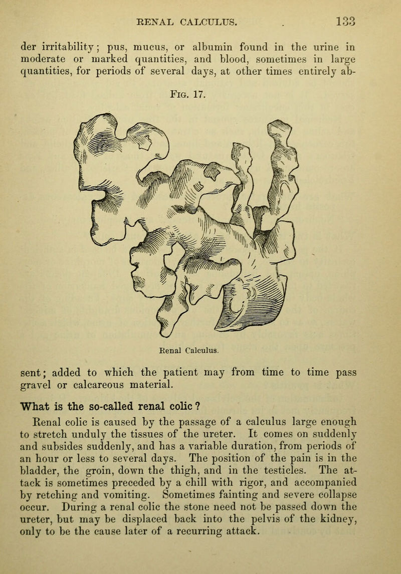 der irritability; pus, mucus, or albumin found in the urine in moderate or marked quantities, and blood, sometimes in large quantities, for periods of several days, at other times entirely ab- FiG. 17. Eenal Calculus. sent; added to which the patient may from time to time pass gravel or calcareous material. What is the so-called renal colic ? Renal colic is caused by the passage of a calculus large enough to stretch unduly the tissues of the ureter. It comes on suddenly and subsides suddenly, and has a variable duration, from periods of an hour or less to several days. The position of the pain is in the bladder, the groin, down the thigh, and in the testicles. The at- tack is sometimes preceded by a chill with rigor, and accompanied by retching and vomiting. Sometimes fainting and severe collapse occur. During a renal colic the stone need not be passed down the ureter, but may be displaced back into the pelvis of the kidney, only to be the cause later of a recurring attack.