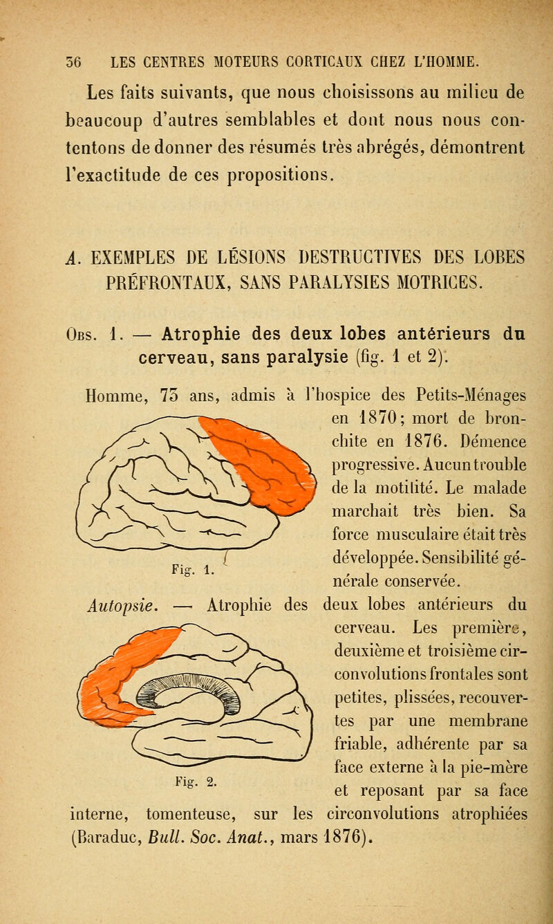 Les faits suivants, que nous choisissons au milieu de beaucoup d'autres semblables et dont nous nous con- tentons de donner des résumés très abrégés, démontrent l'exactitude de ces propositions. A. EXEMPLES DE LÉSIONS DESTRUCTIVES DES LOBES PRÉFRONTALX, SANS PARALYSIES MOTRICES. Obs. 1. — Atrophie des deux lobes antérieurs du cerveau, sans paralysie (fig. 1 et 2). Homme, 75 ans, admis a l'hospice des Petits-xMénages en 1870; mort de bron- chite en 1876. Démence progressive. Aucun trouble de la motilité. Le malade marchait très bien. Sa force musculaire était très développée. Sensibilité gé- nérale conservée. Autopsie. — Atrophie des deux lobes antérieurs du cerveau. Les première, deuxième et troisième cir- convolutions frontales sont petites, plissées, recouver- tes par une membrane friable, adhérente par sa face externe a la pie-mère et reposant par sa face interne, tomenteuse, sur les circonvolutions atrophiées (Baraduc, Bull. Soc. Anat., mars 1876). Fier. 2.