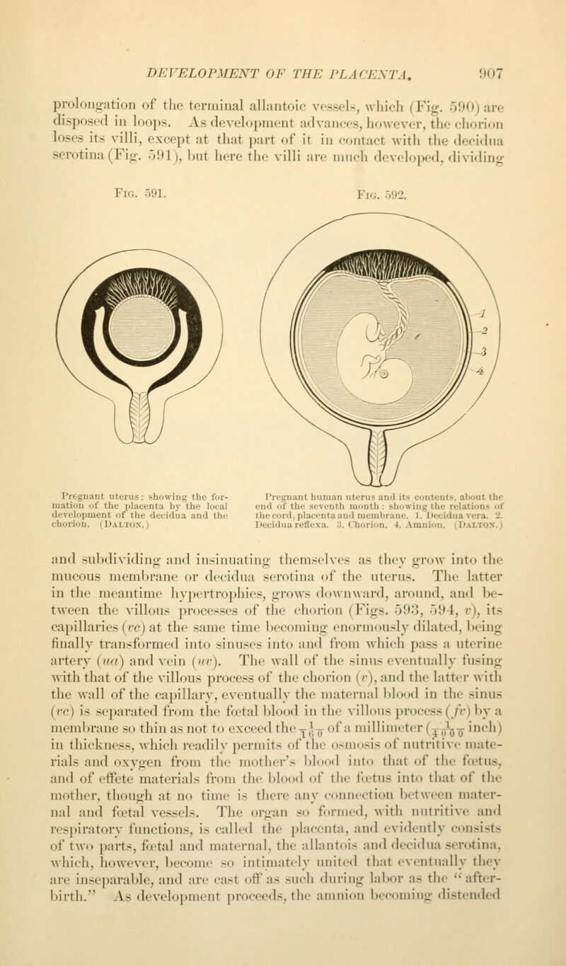 prolongation of the terminal allantoic vessels, which (Fig. 500) are disposed in loops. As development advances, however, the chorion loses its villi, except at that part of it in contact with the decidna serotina (Fig. 591), but here the villi are much developed, dividing Fig. 591. Fig. .092, Preguant uterus : showing the for- matiou of the placenta bv the local development of tlie decidiia and the chorion. ( Dalton. ) Pregnant human uterus and its contents, about the end of the seventh month : showing the relations of the cord, placenta and membrane. 1. Decidua vera. 2. Decidua rellexa. :i. Chorion. 4. Amnion. (Daltox.) and subdividing and insinuating themselves as they grow into the mucous mem])rane or decidua serotina of the uterus. The latter in the meantime hypertrophies, grows downward, around, and be- tAveen the villous processes of the chorion (Figs. 593, 594, v), its capillaries (fc) at the same time becoming enormously dilated, being finally transformed into sinu.scs into and from which pass a uterine artery ('/a) and vein ('•). The wall of the sinus eventually fusing with that of the villous process of the chorion (r), and the latter with the wall of the capillary, eventually the maternal blood in the sinus (vc) is separated from tiie fcetal blood in the villous process(/V)by a memlirane so thin as not to exceed the rj-,^.^ of a millimeter (^yto-q- inch) in thickness, which readily permits of the osmosis of nutritive mate- rials and oxygen from the mother's bloo<l into that of the foetus, and of effete materials from the blood of the ftetus into that of the mother, though at no time is there any connection between mater- nal and ffctal vessels. The organ so formed, with nutritive and respiratory functions, is called the placenta, and evidently consists of two parts, foetal and maternal, the allantois and decidua serotina, which, however, become so intimately united that eventually they are inse])arable, and are cast off as such during labor as the after- birth. As development proceeds, the amnion becoming distended