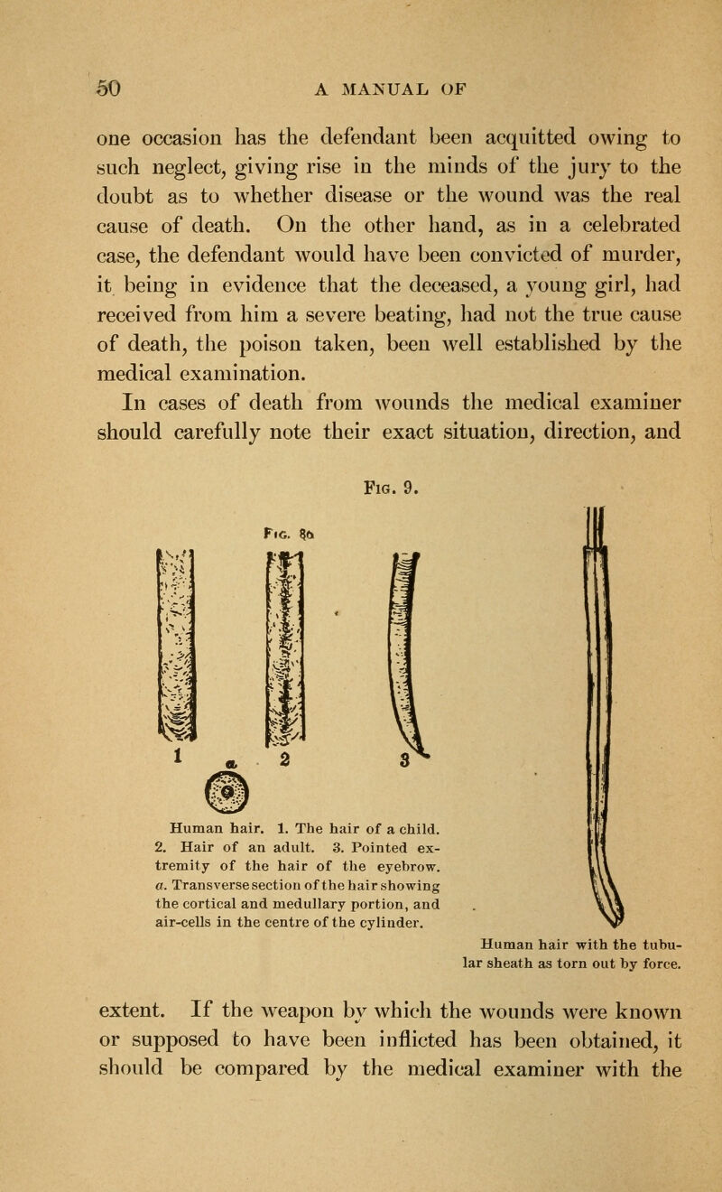 one occasion has the defendant been acquitted owing to such neglect, giving rise in the minds of the jury to the doubt as to whether disease or the wound was the real cause of death. On the other hand, as in a celebrated case, the defendant would have been convicted of murder, it being in evidence that the deceased, a young girl, had received from him a severe beating, had not the true cause of death, the poison taken, been well established by the medical examination. In cases of death from wounds the medical examiner should carefully note their exact situation, direction, and Fig. 9. Fig. ?o ' ft' ) 4-' 1 Human hair. 1. The hair of a child. 2, Hair of an adult. 3. Pointed ex- tremity of the hair of the eyebrow. a. Transversesectionofthe hair showing the cortical and medullary portion, and air-cells in the centre of the cylinder. Human hair with the tubu- lar sheath as torn out by force. extent. If the weapon by which the wounds were known or supposed to have been inflicted has been obtained, it should be compared by the medical examiner with the