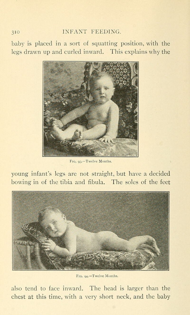 baby is placed in a sort of squatting position, with the legs drawn up and curled inward. This explains why the Fig. 93.—Twelve Months. young infant's legs are not straight, but have a decided bowing in of the tibia and fibula. The soles of the feet Fig. g4.—Twelve Months. also tend to face inward. The head is larger than the chest at this time, with a very short neck, and the baby