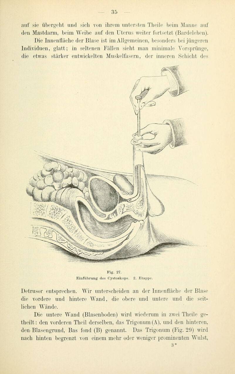 auf sie üborgoht und sich von ihrem unterstfin Theile heim .Mannf auf den Mastdarm, beim Weibe auf den Uterus weiter f(jrts(!tzt (Bardeh.'ben). Die Innenfläche der Blase ist im Allgemeinen, besonders bei jüngeren Individuen, glatt; in seltenen Fällen sieht man minimale Vorsprünge, die etwas stärker entwickelten Muskelfasern, der inneren Seliicbt des Fig. 27. Einführung des Cystoskops. 2. Etappe. Detrusor entsprechen. Wir unterscheiden an der Innenfläche der Blase die vordere und hintere Wand, die obere und untere imd die seit- lichen Wände. Die untere Wand (Blasenboden) wird wiederum in zwei Theile ge- theilt: den vorderen Theil derselben, das Ti-igonum(A). und den hinteren. den-Blasengrund, Bas fond (B) genannt. Das Trigonuni (Fig. 29) wird nach hinten begrenzt von einem mehr oder weniger prominenten Wulst, 3*