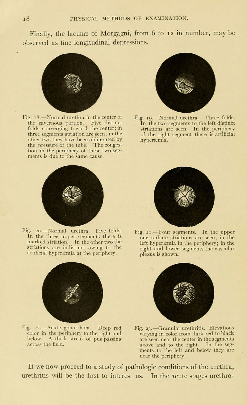 Finally, the lacunae of Morgagni, from 6 to 12 in number, may be observed as fine longitudinal depressions. Fig. 18.—Normal urethra in the center of the cavernous portion. Five distinct folds converging toward the center; in three segments striation are seen; in the other two they have been obliterated by the pressure of the tube. The conges- tion in the periphery of these two seg- ments is due to the same cause. Fig. 19.—Normal urethra. Three folds. In the two segments to the left distinct striations are seen. In the periphery of the right segment there is artificial hyperaemia. Fig. 20.—Normal urethra. Five folds. In the three upper segments there is marked striation. In the other two the striations are indistinct owing to the artificial hyperaemia at the periphery. Fig. 21.—Four segments. In the upper one radiate striations are seen; in the left hyperaemia in the periphery; in the right and lower segments the vascular plexus is shown. Fig. 22.—Acute gonorrhoea. Deep red Fig. 23.—Granular urethritis. Elevations color in the periphery to the right and varying in color from dark red to black below. A thick streak of pus passing are'seen near the center in the segments across the field. above and to the right. In the seg- ments to the left and below they are near the periphery. If we now proceed to a study of pathologic conditions of the urethra, urethritis will be the first to interest us. In the acute stages urethro-