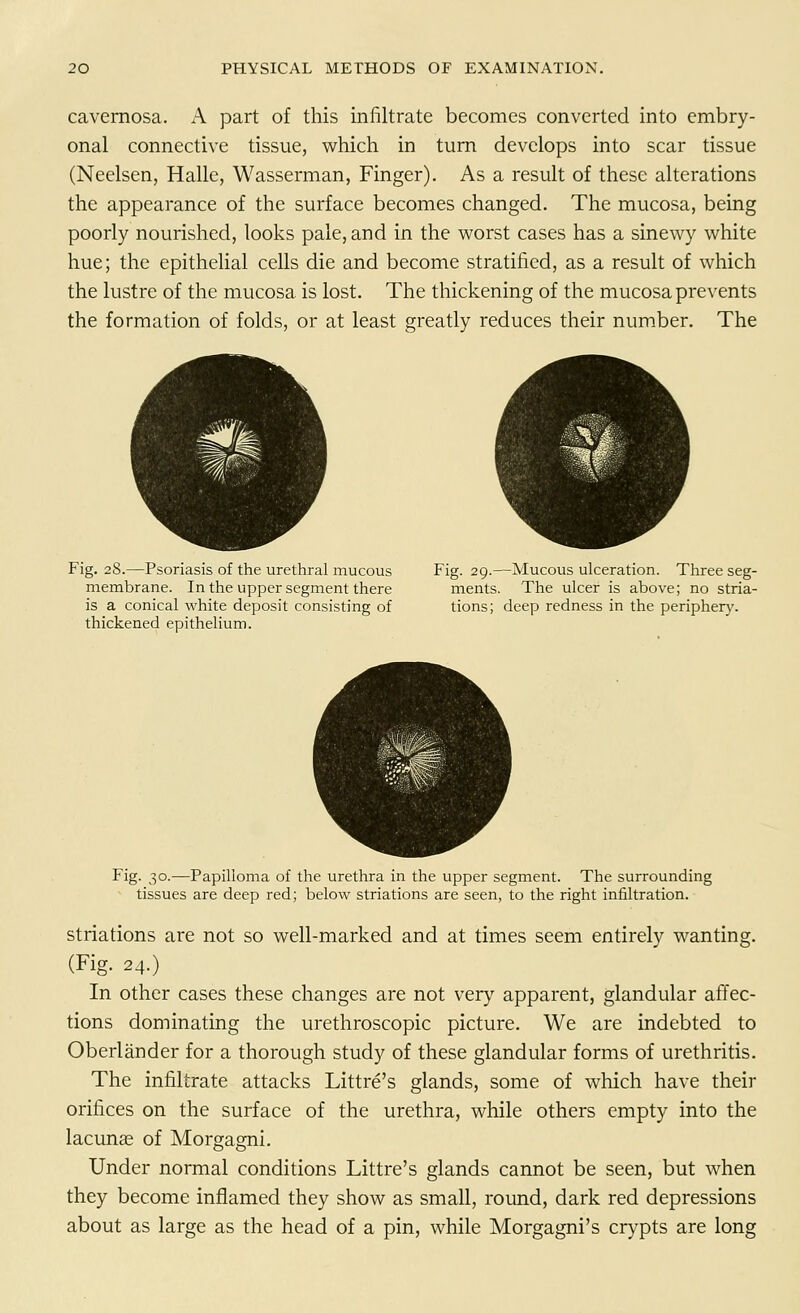 cavernosa. A part of this infiltrate becomes converted into embry- onal connective tissue, which in turn develops into scar tissue (Neelsen, Halle, Wasserman, Finger). As a result of these alterations the appearance of the surface becomes changed. The mucosa, being poorly nourished, looks pale, and in the worst cases has a sinewy white hue; the epithelial cells die and become stratified, as a result of which the lustre of the mucosa is lost. The thickening of the mucosa prevents the formation of folds, or at least greatly reduces their number. The Fig. 28.—Psoriasis of the urethral mucous Fig. 29.—Mucous ulceration. Three seg- membrane. In the upper segment there ments. The ulcer is above; no stria- is a conical white deposit consisting of tions; deep redness in the periphery, thickened epithelium. Fig. 30.—Papilloma of the urethra in the upper segment. The surrounding tissues are deep red; below striations are seen, to the right infiltration. striations are not so well-marked and at times seem entirely wanting. (Fig. 24.) In other cases these changes are not very apparent, glandular affec- tions dominating the urethroscopic picture. We are indebted to Oberlander for a thorough study of these glandular forms of urethritis. The infiltrate attacks Littre's glands, some of which have their orifices on the surface of the urethra, while others empty into the lacunas of Morgagni. Under normal conditions Littre's glands cannot be seen, but when they become inflamed they show as small, round, dark red depressions about as large as the head of a pin, while Morgagni's crypts are long
