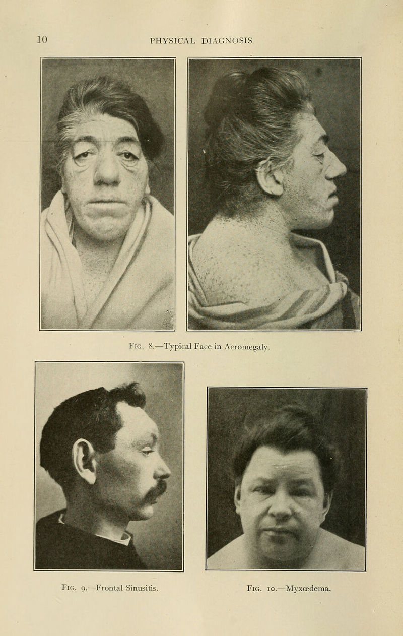 Fig. 8.—Typical Face in Acromegaly. Fig. 9.—Frontal Sinusitis. Fig. 10.—Myxoedema.