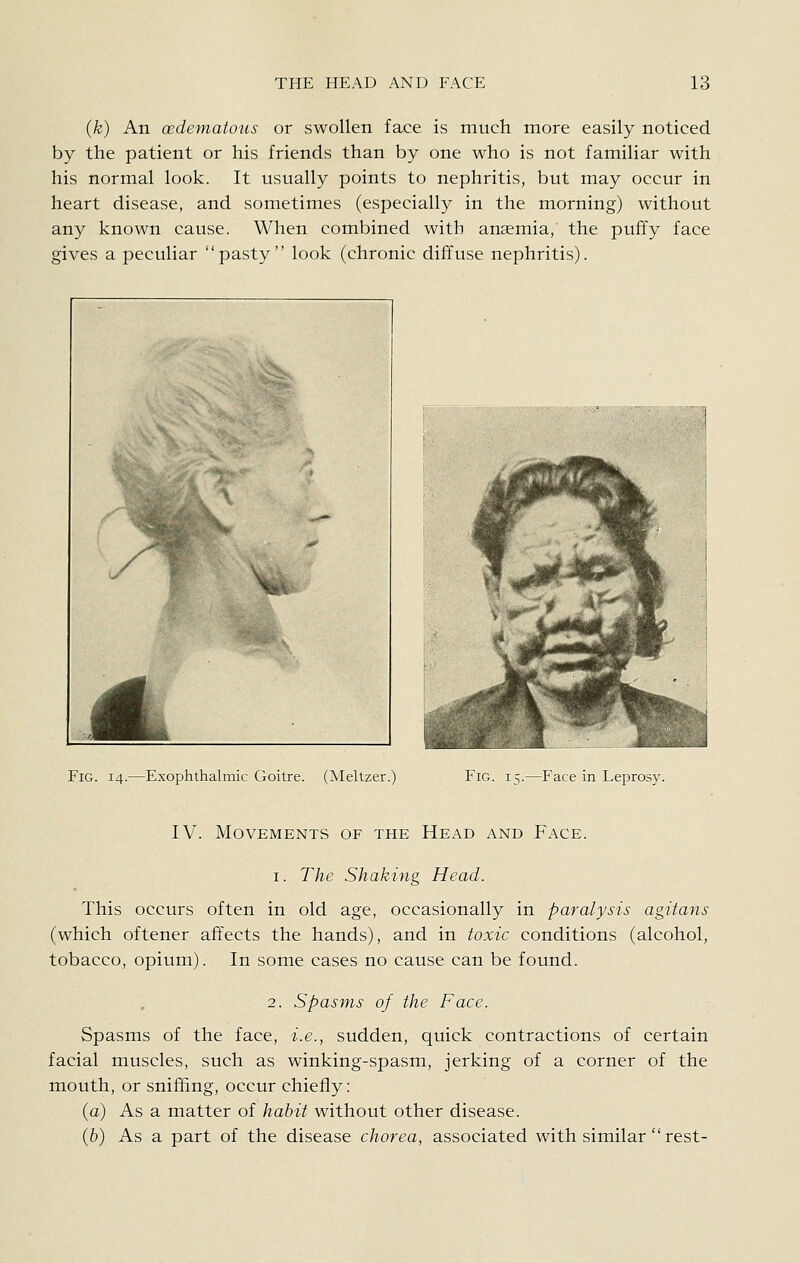 (k) An (Edematous or swollen face is much more easily noticed by the patient or his friends than by one who is not familiar with his normal look. It usually points to nephritis, but may occur in heart disease, and sometimes (especially in the morning) without any known cause. When combined with anaemia, the puffy face gives a peculiar pasty look (chronic diffuse nephritis). Fig. 14.—Exophthalmic Goitre. (Meltzer.) Fig. 15.—Face in Leprosy. IV. Movements of the Head and Face. I. The Shaking Head. This occurs often in old age, occasionally in paralysis agitans (which oftener affects the hands), and in toxic conditions (alcohol, tobacco, opium). In some cases no cause can be found. 2. Spasms of the Face. Spasms of the face, i.e., sudden, quick contractions of certain facial muscles, such as winking-spasm, jerking of a corner of the mouth, or sniffing, occur chiefly: (a) As a matter of habit without other disease. (b) As a part of the disease chorea, associated with similar  rest-