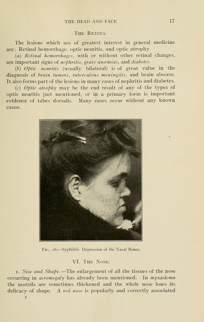 The Retina. The lesions which are of greatest interest in general medicine are: Retinal hemorrhage, optic neuritis, and optic atrophy. (a) Retinal hemorrhages, with or without other retinal changes, are important signs of nephritis, grave ancemias, and diabetes. {b) Optic neuritis (usually bilateral) is of great value in the diagnosis of brain tumors, tuberculous meningitis, and brain abscess. It also forms part of the lesions in many cases of nephritis and diabetes. (c) Optic atrophy may be the end result of any of the types of optic neuritis just mentioned, or in a primary form is important evidence of tabes dorsalis. Many cases occur without any known cause. Fig. 16.-—Syphilitic Depression of the Nasal Bones. VI. The Nose. I. Size and Shape.—^The enlargement of all the tissues of the nose occurring in acromegaly has already been mentioned. In myxoedema the nostrils are sometimes thickened and the whole nose loses its delicacy of shape. A red nose is popularly and correctly associated