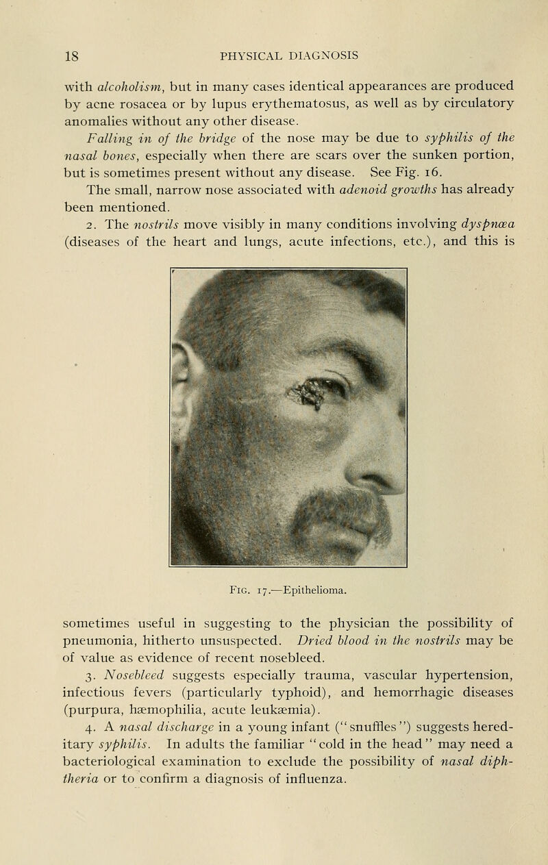 with alcoholism, but in many cases identical appearances are produced by acne rosacea or by lupus erythematosus, as well as by circulatory anomalies without any other disease. Falling in of the bridge of the nose may be due to syphilis of the nasal hones, especially when there are scars over the sunken portion, but is sometimes present without any disease. See Fig. i6. The small, narrow nose associated with adenoid growths has already been mentioned. 2. The nostrils move visibly in many conditions involving dyspnoea (diseases of the heart and lungs, acute infections, etc.), and this is Fig. 17.—Epithelioma. sometimes useful in suggesting to the physician the possibility of pneumonia, hitherto unsuspected. Dried blood in the nostrils may be of value as evidence of recent nosebleed. 3. Nosebleed suggests especially trauma, vascular hypertension, infectious fevers (particularly typhoid), and hemorrhagic diseases (purpura, haemophilia, acute leukaemia). 4. A nasal discharge in a young infant ( snuffles ) suggests hered- itary syphilis. In adults the familiar cold in the head may need a bacteriological examination to exclude the possibility of nasal diph- theria or to confirm a diagnosis of influenza.