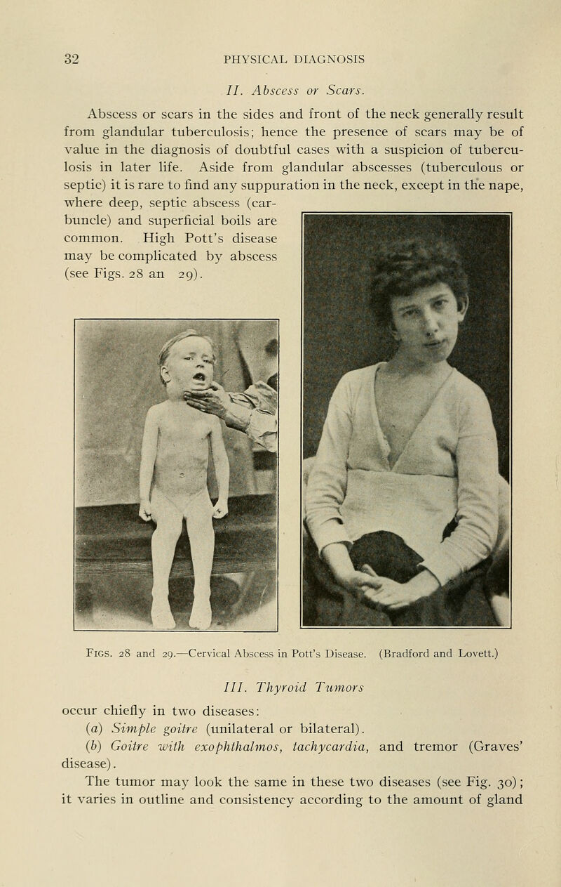 //. Abscess or Scars. Abscess or scars in the sides and front of the neck generally result from glandular tuberculosis; hence the presence of scars may be of value in the diagnosis of doubtful cases with a suspicion of tubercu- losis in later life. Aside from glandular abscesses (tuberculous or septic) it is rare to find any suppuration in the neck, except in the nape, where deep, septic abscess (car- buncle) and superficial boils are common. High Pott's disease may be complicated by abscess (see Figs. 28 an 29). Figs. 28 and 29.—Cervical Abscess in Pott's Disease. (Bradford and Lovett.) ///. Thyroid Tumors occur chiefly in two diseases: (a) Simple goitre (unilateral or bilateral). (6) Goitre with exophthalmos, tachycardia, and tremor (Graves' disease). The tumor may look the same in these two diseases (see Fig. 30); it varies in outline and consistency according to the amount of gland