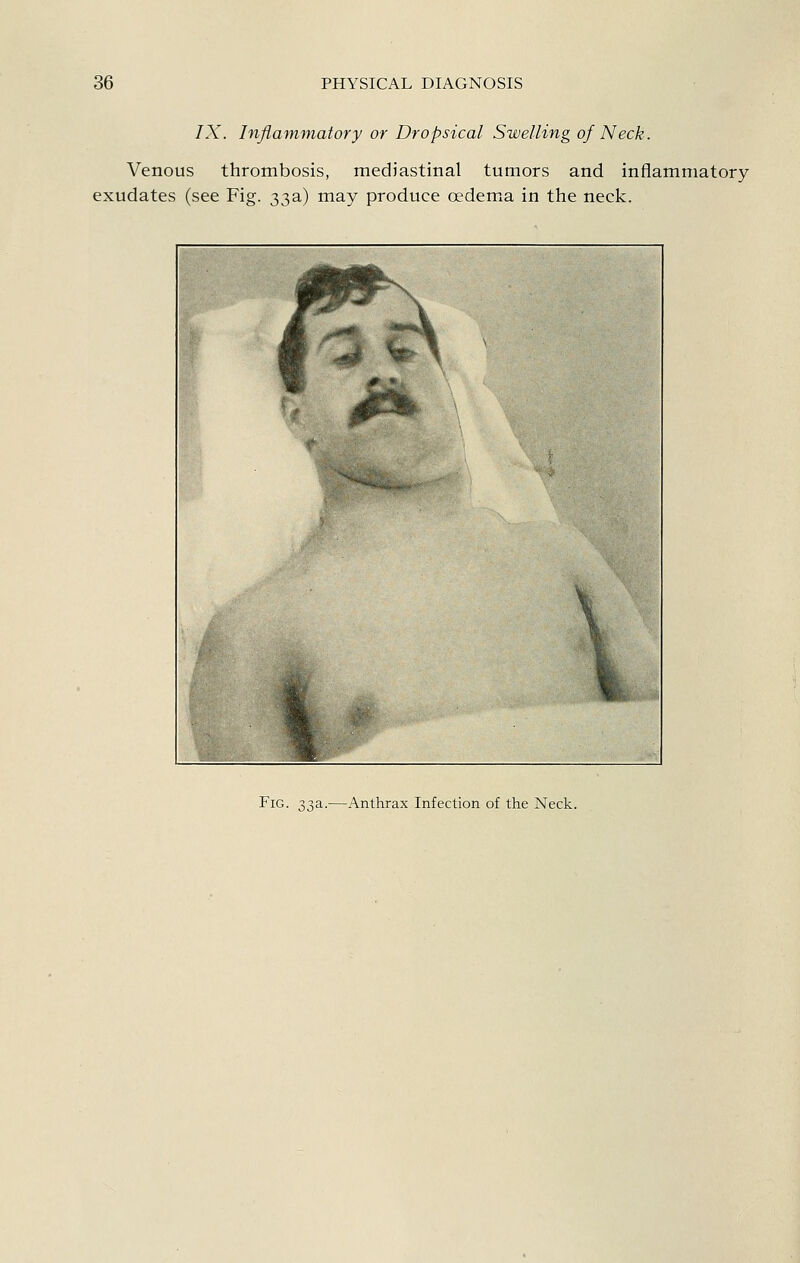 IX. Inflammatory or Dropsical Swelling of Neck. Venous thrombosis, mediastinal tumors and inflammatory exudates (see Fig. 33a) may produce oedema in the neck. Fig. -^^a.—Anthrax Infection of the Neck.