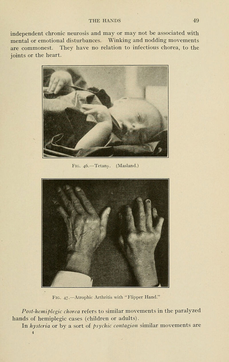 independent chronic neurosis and may or may not be associated with mental or emotional disturbances. Winking and nodding movements are commonest. They have no relation to infectious chorea, to the joints or the heart. Fig. 46.—Tetany. (Masland.) Fig. 47.—Atrophic Arthritis with FUpper Hand. Post-hemiplegic chorea refers to similar movements in the paralyzed hands of hemiplegic cases (children or adults). In hysteria or by a sort of psychic contagion similar movements are 4