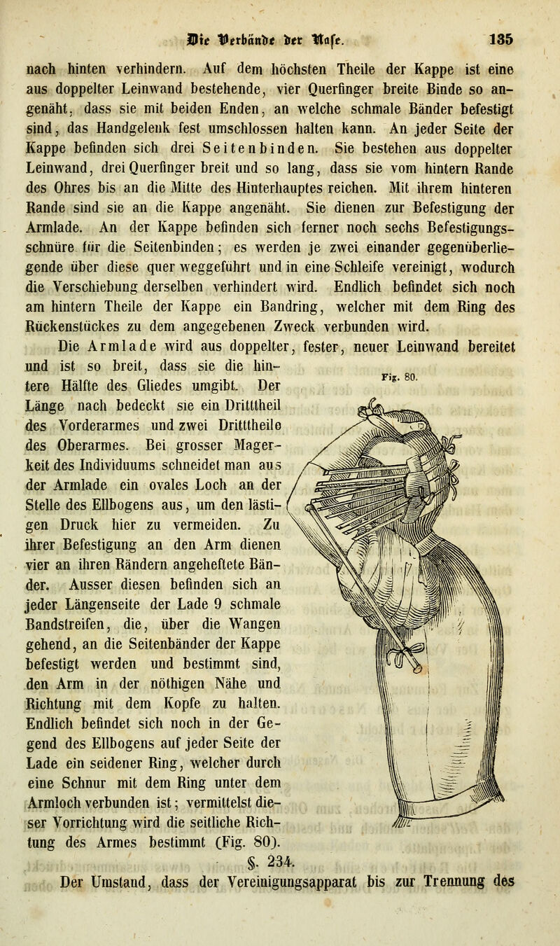 Fig. 80. nach hinten verhindern. Auf dem höchsten Theile der Kappe ist eine aus doppelter Leinwand bestehende, vier Querfinger breite Binde so an- genäht, dass sie mit beiden Enden, an welche schmale Bänder befestigt sind, das Handgelenk fest umschlossen halten kann. An jeder Seite der Kappe befinden sich drei Seiten binden. Sie bestehen aus doppelter Leinwand, drei Querfinger breit und so lang, dass sie vom hintern Rande des Ohres bis an die Mitte des Hinterhauptes reichen. Mit ihrem hinteren Rande sind sie an die Rappe angenäht. Sie dienen zur Befestigung der Armlade. An der Kappe befinden sich ferner noch sechs Befestigungs- schnüre für die Seitenbinden; es werden je zwei einander gegenriberUe- gende über diese quer weggeführt und in eine Schleife vereinigt, wodurch die Verschiebung derselben verhindert wird. Endlich befindet sich noch am hintern Theile der Kappe ein Bandring, welcher mit dem Ring des Rückenstückes zu dem angegebenen Zweck verbunden wird. Die Armlade wird aus doppelter, fester, neuer Leinwand bereitet und ist so breit, dass sie die hin- tere Hälfte des Gliedes umgibt. Der Länge nach bedeckt sie ein Dritttheil des Vorderarmes und zwei Dritttheilo des Oberarmes. Bei grosser Mager- keit des Individuums schneidet man aus der Armlade ein ovales Loch an der Stelle des Ellbogens aus, um den lästi- gen Druck hier zu vermeiden. Zu ihrer Befestigung an den Arm dienen vier an ihren Rändern angeheftete Bän- der. Ausser diesen befinden sich an jeder Längenseite der Lade 9 schmale Bandstreifen, die, über die Wangen gehend, an die Seitenbänder der Kappe befestigt werden und bestimmt sind, den Arm in der nöthigen Nähe und Richtung mit dem Kopfe zu halten. Endlich befindet sich noch in der Ge- gend des Ellbogens auf jeder Seite der Lade ein seidener Ring, welcher durch eine Schnur mit dem Ring unter dem I Armloch verbunden ist; vermittelst die- [ser Vorrichtung wird die seithche Rich- tung des Armes bestimmt (Fig. 80). §. 234. Der Umstand, dass der Vereinigungsapparat bis zur Trennung des