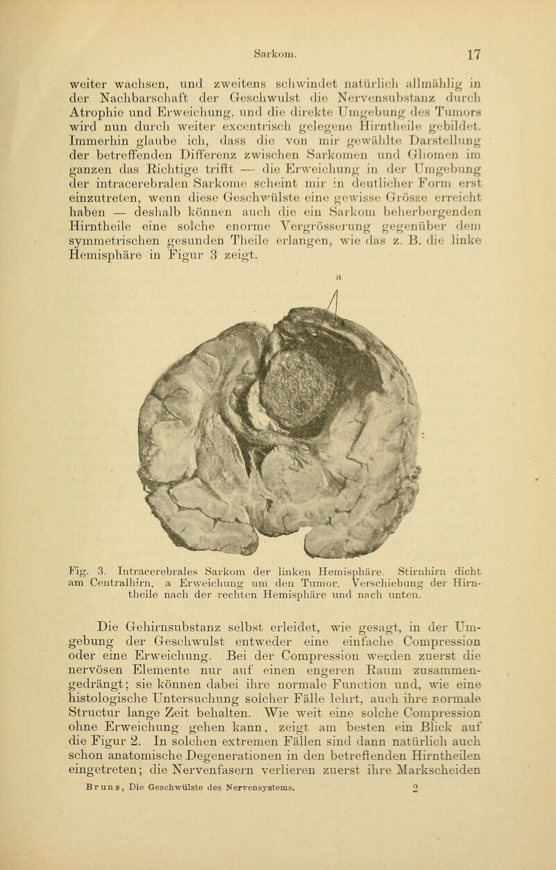 weiter wachsen, und zweitens sf;livvi/](l(;t iialürlicli iiJliriählig in der Nachbarschaft der Geschwulst (iif; Nci-vcnsuhstanz dui'ch Atrophie und Erweichung, und die direkte Umgebung dos Tumors wird nun durcli weiter exccntrisch gelegf^ne Hii-ntliei]«; gebildet. Immerhin glaube ich, dass die von mir gewtUilte Darstellung der betreffenden Differenz zwischen Sarkomen und Gliomen im ganzen das Richtige trifft — die Erweichung in der Umgebung der intracerebralen Sarkome scheint mir in deutlicher Form erst einzutreten, wenn diese Geschväilste eine gewisse Grösse erreicht haben — deshalb können auch die ein Sarkom beherbergenden. Hirntheile eine soh;lie enorme Vergrösserung gegenüber dem symmetrisciien gesunden Theile erlangen, wie das z. B. die linke Hemisphäre in Figur 3 zeigt. Fig. 3. Intracerebrales Sarkom der linken Hemisphäre. Stirnhirn dicht am Centralhirn. a Erweichung um den Tumor. Verschiebung der Hirn- theile nach der rechten Hemisphäre und nach unten. Die Gehirnsubstanz selbst erleidet, wie gesagt, in der Um- gebung der Geschwulst entweder eine einfache Compression oder eine Erweichung. Bei der Compression werden zuerst die nervösen Elemente nur auf einen engeren Kaum zusammen- gedrängt; sie können dabei ihre normale Function und, wie eine histologische Untersuchung solcher Fälle lehrt, auch ihre normale Structur lange Zeit behalten. Wie weit eine solche Compression ohne Erweichung gehen kann, zeigt am besten ein Blick auf die Figur 2. In solchen extremen Fällen sind dann natürlich auch schon anatomische Degenerationen in den betreffenden Hirntheilen eingetreten; die Nervenfasei'n verlieren zuerst ihre Markscheiden Bruns, Die Geschwülste des Nervensystems. 2