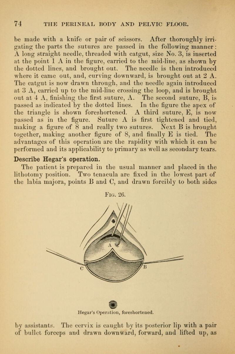 be made with a knife or pair of scissors. After thoroughly irri- gating the parts the sutures are passed in the following manner: A long straight needle, threaded with catgut, size No. 3, is inserted at the point 1 A in the figure, carried to the mid-line, as shown by the dotted lines, and brought out. The needle is then introduced where it came out, and, curving downward, is brought out at 2 A. The catgut is now drawn through, and the needle again introduced at 3 A, carried up to the mid-line crossing the loop, and is brought out at 4 A, finishing the first suture, iV. The second suture, B, is passed as indicated by the dotted lines. In the figure the apex of the triangle is shown foreshortened. A third suture. E, is now passed as in the figure. Suture A is first tightened and tied, making a figure of 8 and really two sutures. Next B is brought together, making another figure of 8, and finally E is tied. The advantages of this operation are the rapidity with which it can be performed and its applicability to primary as well as secondary tears. Describe Hegar's operation. The patient is prepared in the usual manner and placed in the lithotomy position. Two tenacula are fixed in the lowest part of the labia majora, points B and C, and drawn forcibly to both sides Fig. 2G. Hegar's Operation, foreshortened. by assistants. The cervix is caught by its posterior lip with a pair of bullet forceps and drawn downward, forward, and lifted up, as