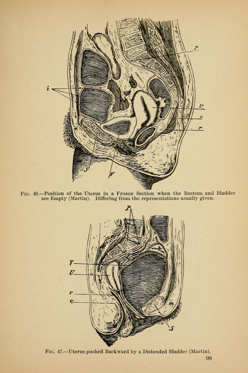 Fig. 46.—Position of the Uterus in a Frozen Section when the Rectum and Bladder are Empty (Martin). Differing from the representations usually given. Fig. 47.—Uterus pushed Backward by a Distended Bladder (Martin).