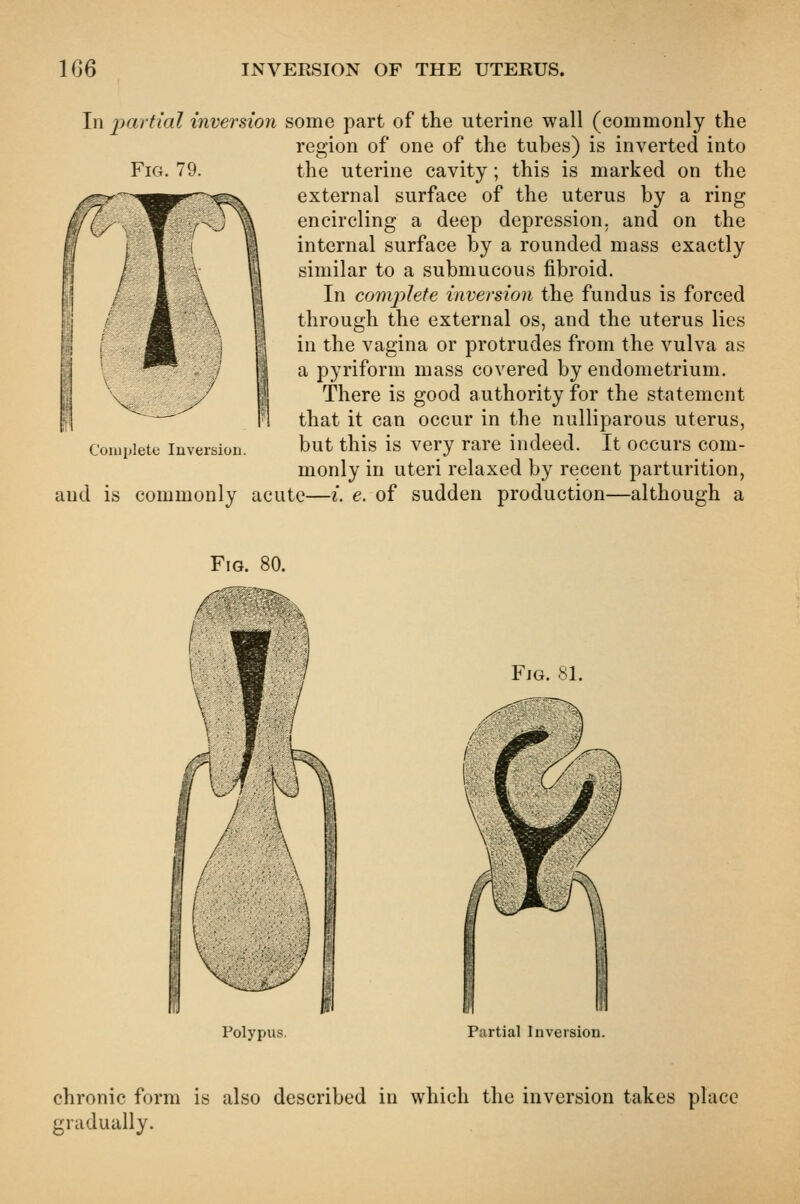 Fig. 79. In partial inversion some part of the uterine wall (commonly the region of one of the tubes) is inverted into the uterine cavity; this is marked on the external surface of the uterus by a ring encircling a deep depression, and on the internal surface by a rounded mass exactly similar to a submucous fibroid. In comj)lete inversion the fundus is forced through the external os, and the uterus lies in the vagina or protrudes from the vulva as a pyriform mass covered by endometrium. There is good authority for the statement that it can occur in the nulliparous uterus, but this is very rare indeed. It occurs com- monly in uteri relaxed by recent parturition, and is commonly acute—i. e. of sudden production—although a Coiuplete Inversion. Fig. 80. Fig. 81. Polypus. Partial Inversion. chronic form is also described in which the inversion takes place gradually.