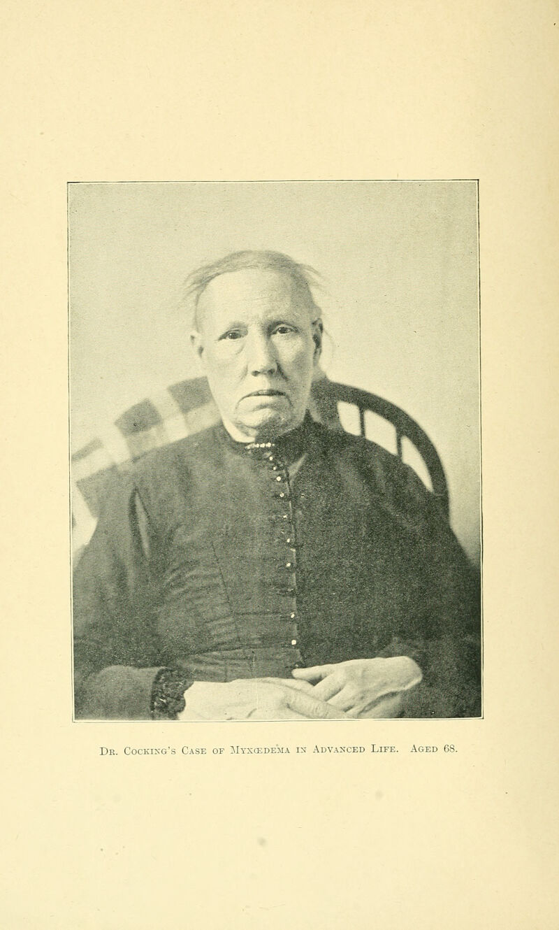 Dr. Cooking's Case of Myxedema in Advanced Life. Aged 68.