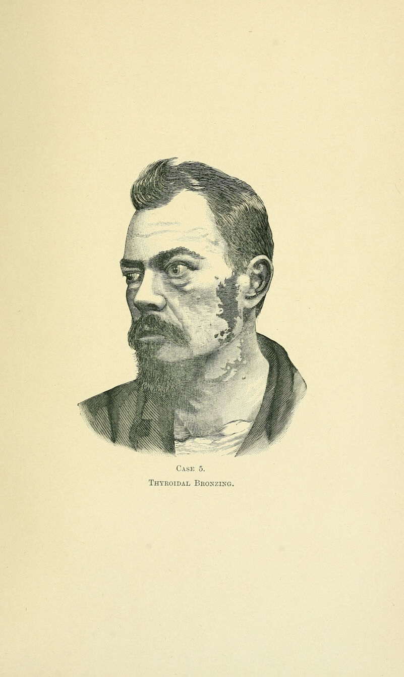 Case 5. Thyroidal Bronzing.