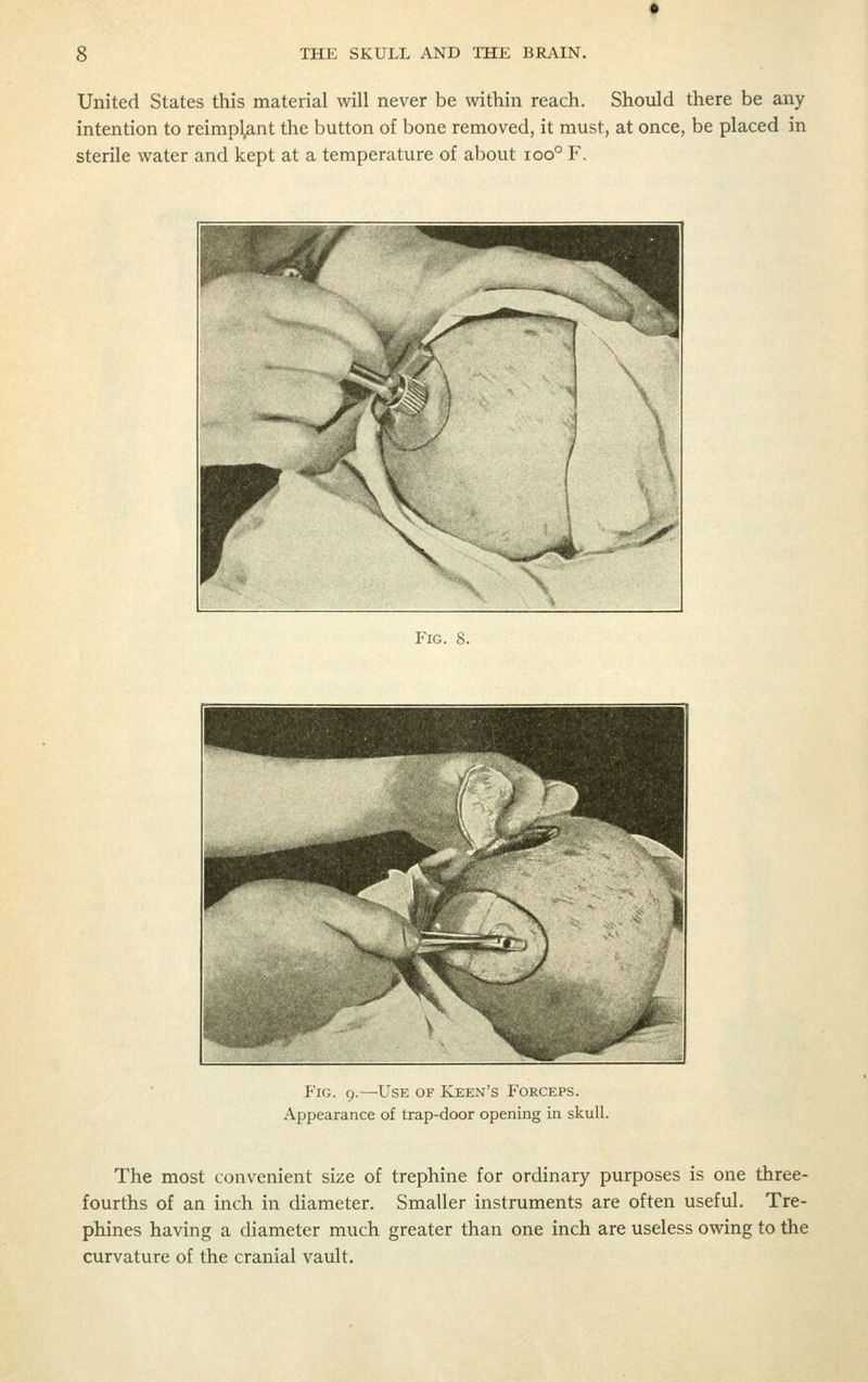 United States this material will never be within reach. Should there be any intention to reimpl^nt the button of bone removed, it must, at once, be placed in sterile water and kept at a temperature of about ioo° F. Fig. 8. Fig. 9.^Use of Keen's Forceps. Appearance of trap-door opening in skull. The most convenient size of trephine for ordinary purposes is one three- fourths of an inch in diameter. Smaller instruments are often useful. Tre- phines having a diameter much greater than one inch are useless owing to the curvature of the cranial vault.