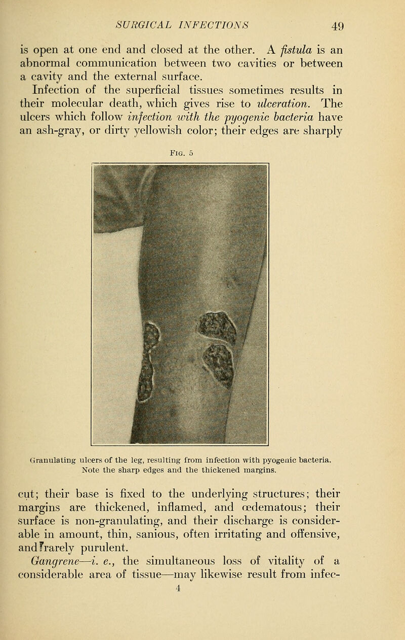 is open at one end and closed at the other. A fistula is an abnormal communication between two cavities or between a cavity and the external surface. Infection of the superficial tissues sometimes results in their molecular death, which gives rise to ulceration. The ulcers which follow infection with the pyogenic bacteria have an ash-gray, or dirty yellowish color; their edges are sharply Fig. 5 Granulating ulcers of the leg, resulting from infection witb pyogenic bacteria. Note the sharp edges and the thickened margins. cut; their base is fixed to the underlying structures; their margins are thickened, inflamed, and oedematous; their surface is non-granulating, and their discharge is consider- able in amount, thin, sanious, often irritating and offensive, andFrarely purulent. Gangrene—i. e., the simultaneous loss of vitality of a considerable area of tissue—may likewise result from infec- 4