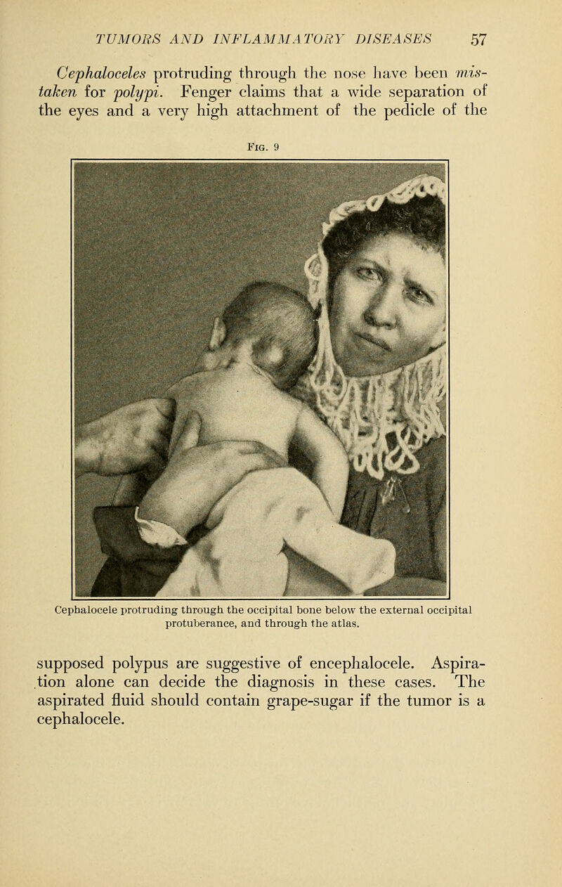 Cephaloceles protruding through the nose have been mis- taken for polypi. Fenger claims that a wide separation of the eyes and a very high attachment of the pedicle of the Fig. 9 Cephalocele protruding through the occipital bone below the external occipital protuberance, and through the atlas. supposed polypus are suggestive of encephalocele. Aspira- .tion alone can decide the diagnosis in these cases. The aspirated fluid should contain grape-sugar if the tumor is a cephalocele.