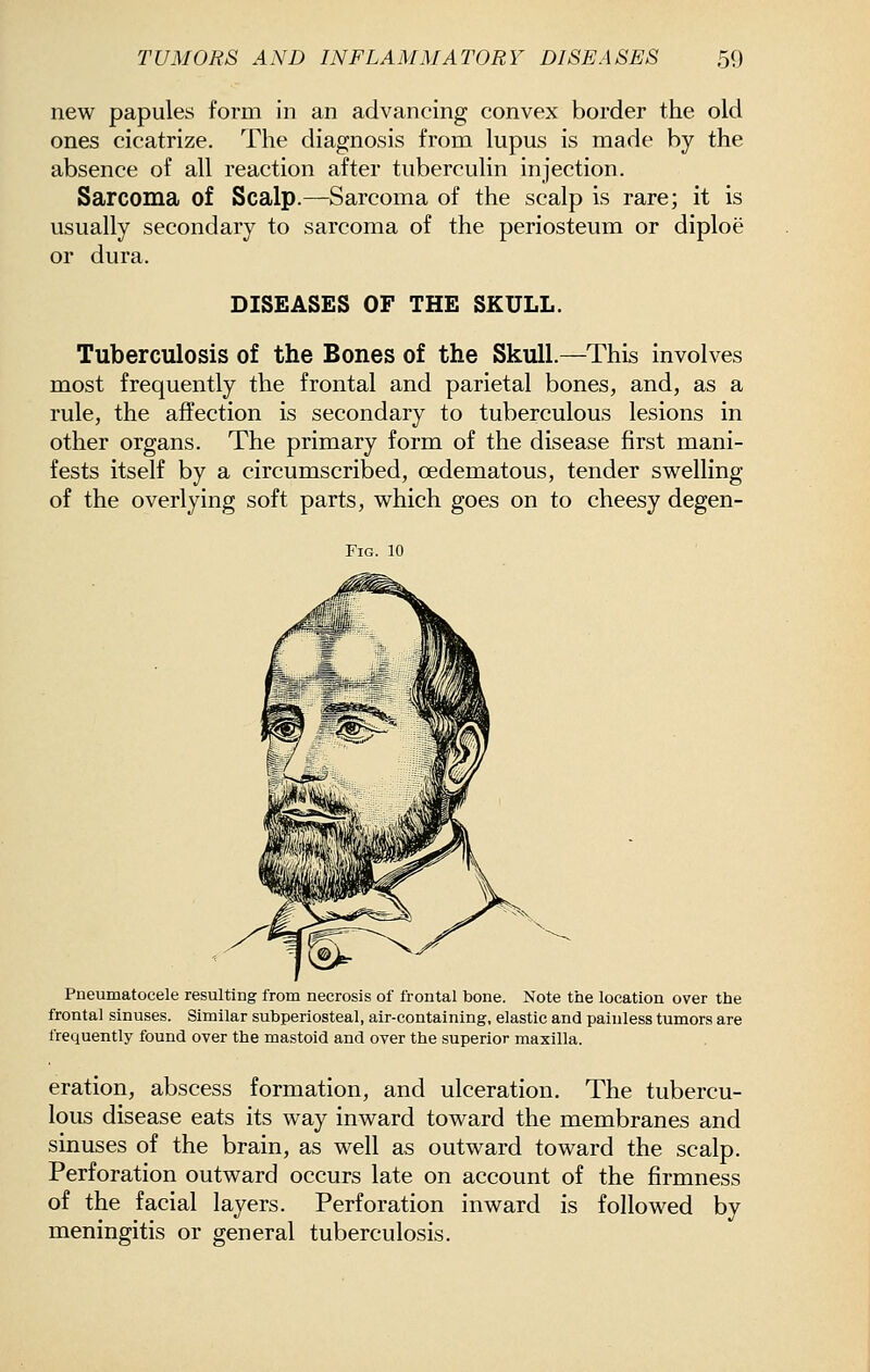 new papules form in an advancing convex border the old ones cicatrize. The diagnosis from lupus is made by the absence of all reaction after tuberculin injection. Sarcoma of Scalp.—Sarcoma of the scalp is rare; it is usually secondary to sarcoma of the periosteum or diploe or dura. DISEASES OF THE SKULL. Tuberculosis of the Bones of the Skull.—This involves most frequently the frontal and parietal bones, and, as a rule, the affection is secondary to tuberculous lesions in other organs. The primary form of the disease first mani- fests itself by a circumscribed, oedematous, tender swelling of the overlying soft parts, which goes on to cheesy degen- FiG. 10 Pneumatocele resulting from necrosis of frontal bone. Note the location over the frontal sinuses. Similar subperiosteal, air-containing, elastic and painless tumors are frequently found over the mastoid and over the superior maxilla. eration, abscess formation, and ulceration. The tubercu- lous disease eats its way inward toward the membranes and sinuses of the brain, as well as outward toward the scalp. Perforation outward occurs late on account of the firmness of the facial layers. Perforation inward is followed by meningitis or general tuberculosis.