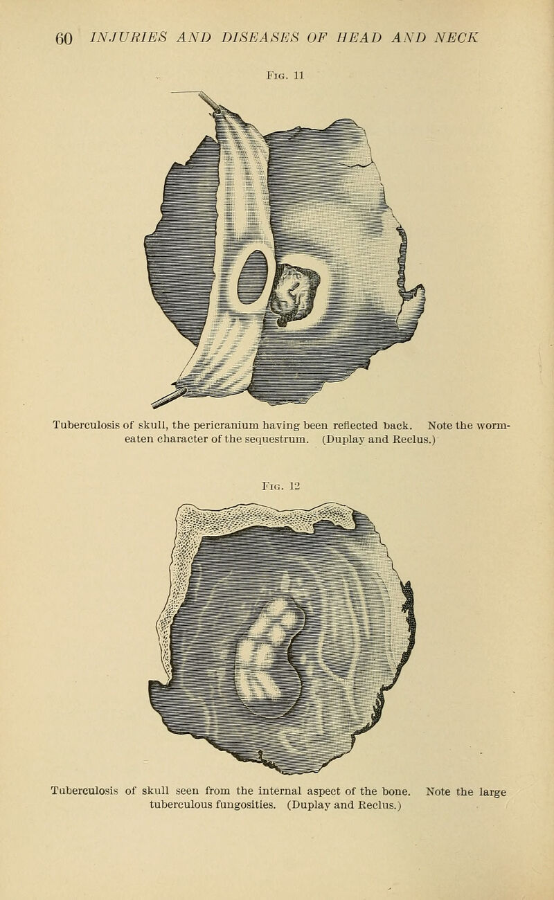 Fig. 11 Tuberculosis of skull, the pericranium having been reflected back. Note the worm- eaten character of the sequestrum. (Duplay and Reclus.) Fig. 12 Tuberculosis of skull seen from the internal aspect of the bone. Note the large tuberculous fungosities. (Duplay and Reclus.)
