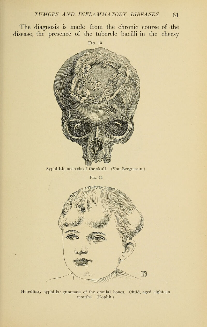 The diagnosis is made from the chronic course of the disease, the presence of the tubercle bacilh in the cheesy Fig. 13 Syphilitic necrosis of the skull. (Von Bergmann.) Fig.14 Hereditary syphilis: gumraata of the cranial bones. Child, aged eighteen months. (Koplik.)