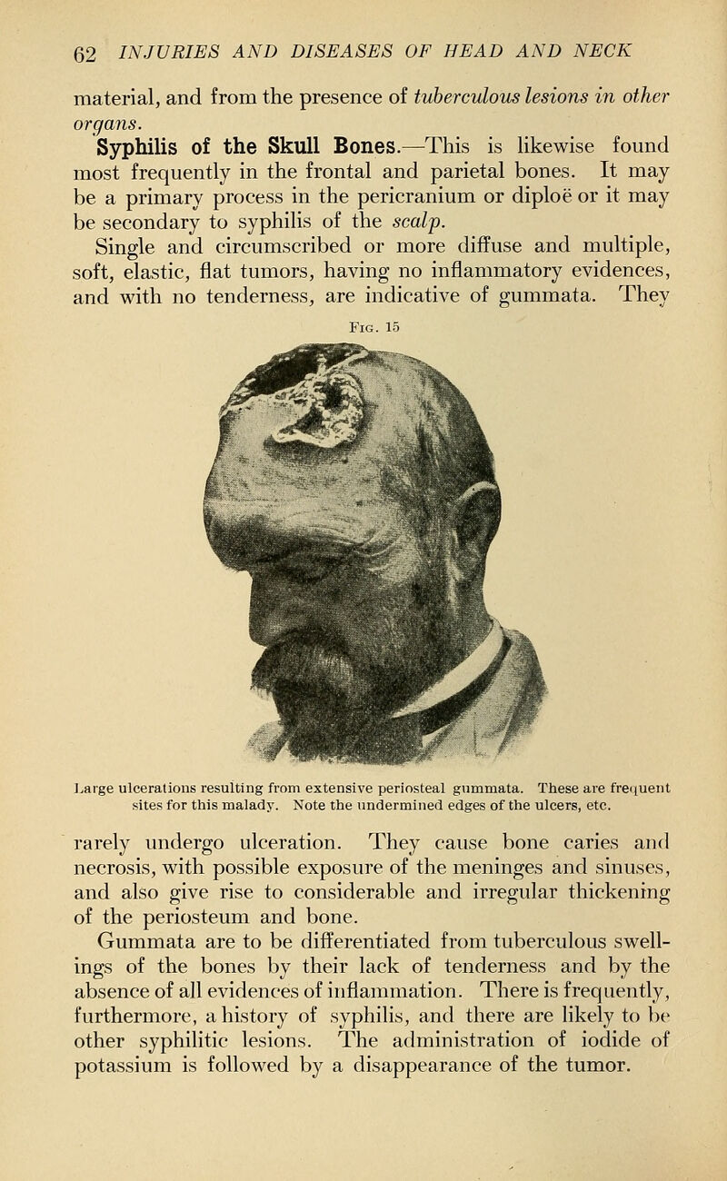 material, and from the presence of tuberculous lesions in other organs. Syphilis of the Skull Bones.—This is likewise found most frequently in the frontal and parietal bones. It may be a primary process in the pericranium or diploe or it may be secondary to syphilis of the scalp. Single and circumscribed or more diffuse and multiple, soft, elastic, flat tumors, having no inflammatory evidences, and with no tenderness, are indicative of gummata. They Fig. 15 ]>arge ulcerations resulting from extensive periosteal gummata. These are frequent sites for this malady. Note the undermined edges of the ulcers, etc. rarely undergo ulceration. They cause bone caries and necrosis, with possible exposure of the meninges and sinuses, and also give rise to considerable and irregular thickening of the periosteum and bone. Gummata are to be differentiated from tuberculous swell- ings of the bones by their lack of tenderness and by the absence of all evidences of inflammation. There is frequently, furthermore, a history of syphilis, and there are likely to be other syphilitic lesions. The administration of iodide of potassium is followed by a disappearance of the tumor.