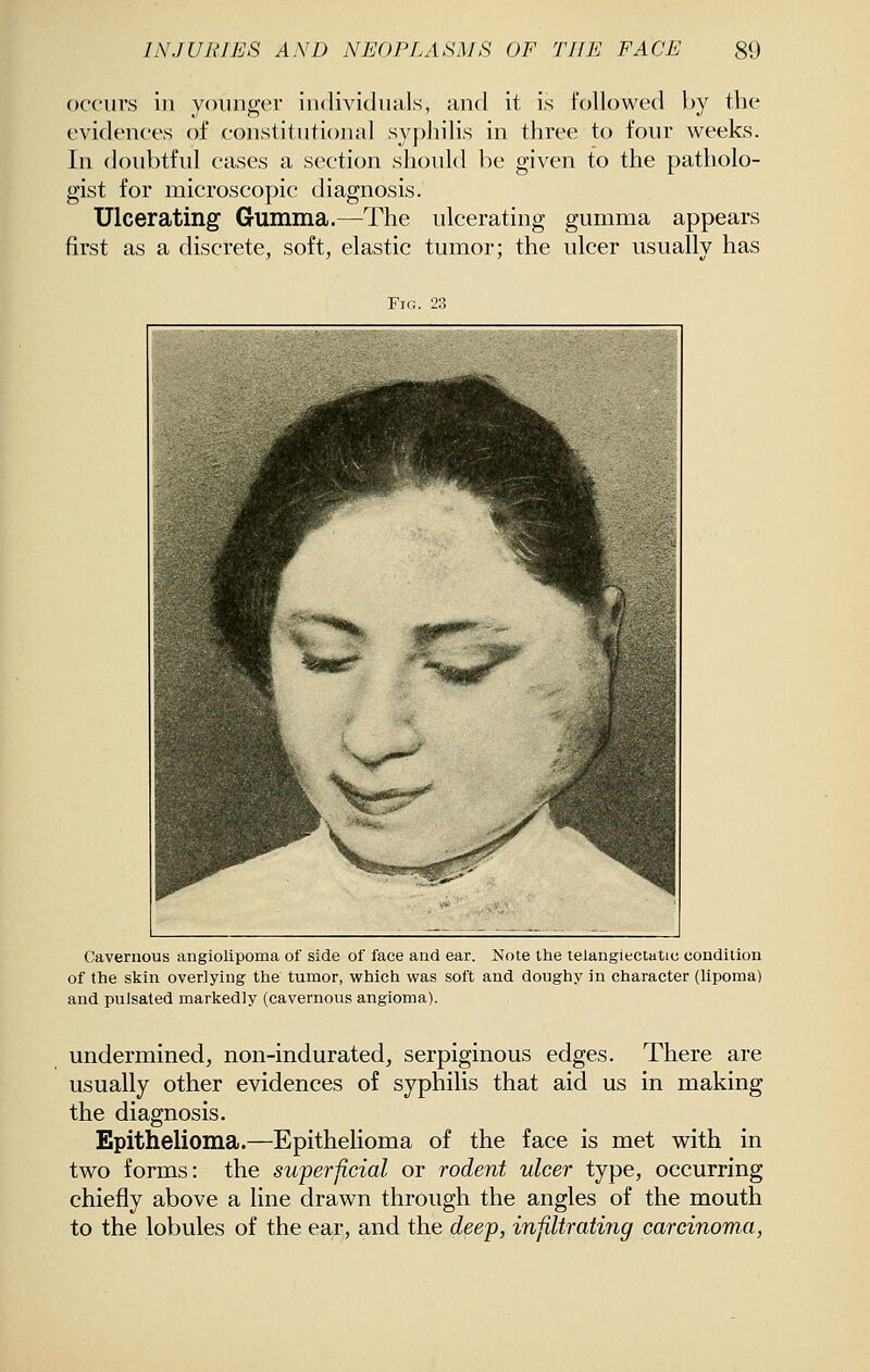 occurs in younger individuals, and it is followed by the evidences of constitutional syphilis in three to four weeks. In doubtful cases a section should be given to the patholo- gist for microscopic diagnosis. Ulcerating Gumma.—The ulcerating gumma appears first as a discrete, soft, elastic tumor; the ulcer usually has Fin. 23 Cavernous angiolipoma of side of face and ear. Note the telangiectatic condition of the skin overlying the tumor, which was soft and doughy in character (lipoma) and pulsated markedly (cavernous angioma). undermined, non-indurated, serpiginous edges. There are usually other evidences of syphilis that aid us in making the diagnosis. Epithelioma.—Epithelioma of the face is met with in two forms: the superficial or rodent ulcer type, occurring chiefly above a line drawn through the angles of the mouth to the lobules of the ear, and the deep, infiltrating carcinoma,