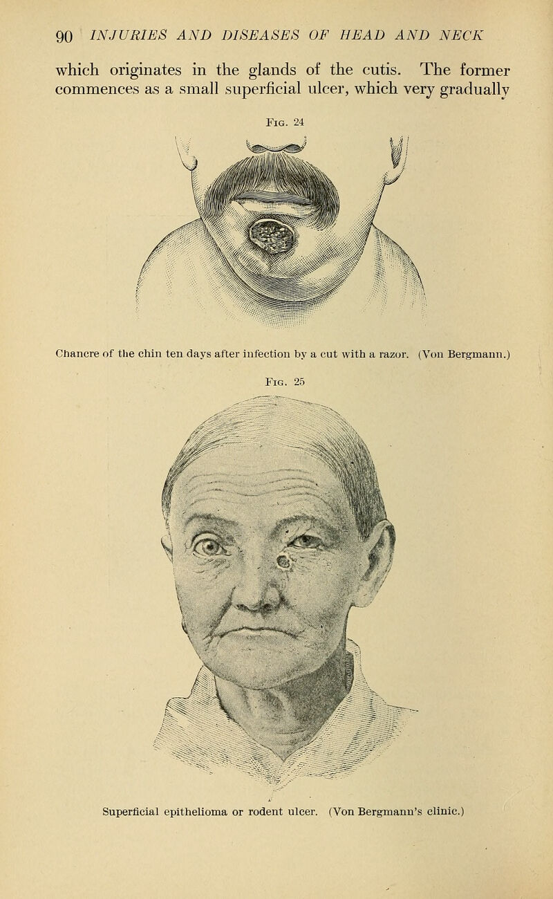 which originates in the glands of the cutis. The former commences as a small superficial ulcer, which very gradually Fig. 24 Chancre of the chin ten days after infection by a cut with a razor. (Von Bergmann.) Fig. 25 i* ± K '-' m \ Superficial epithelioma or rodent ulcer. (Von Bergmann's clinic.)
