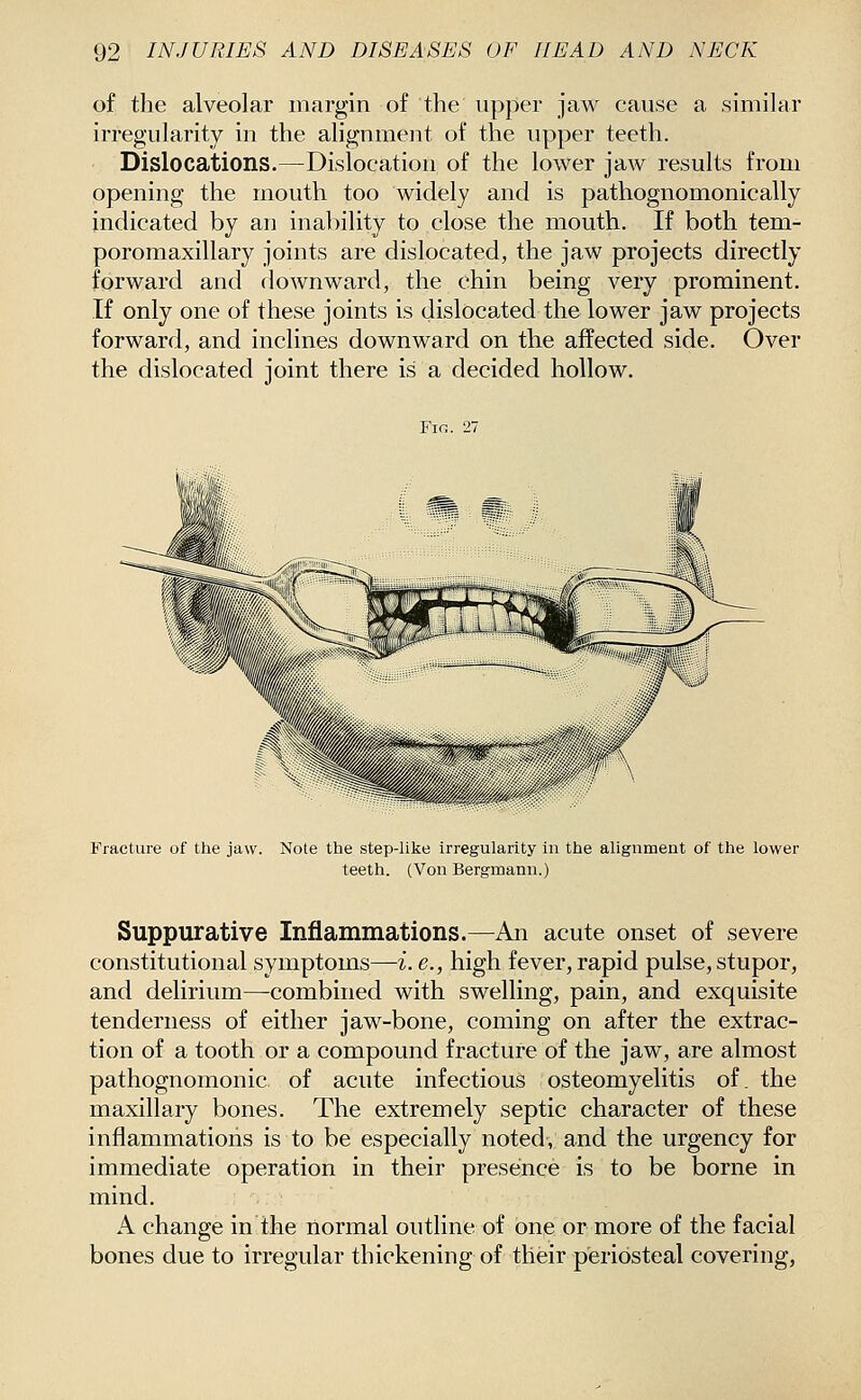 of the alveolar margin of the upper jaw cause a similar irregularity in the alignment of the upper teeth. Dislocations.—Dislocation of the lower jaw results from opening the mouth too widely and is pathognomonically indicated by an inability to close the mouth. If both tem- poromaxillary joints are dislocated, the jaw projects directly forward and downward, the chin being very prominent. If only one of these joints is dislocated the lower jaw projects forward, and inclines downward on the affected side. Over the dislocated joint there is a decided hollow. Fig. 27 Fracture of the jaw. Note the step-like irregularity in the alignment of the lower teeth. (Von Bergmann.) Suppurative Inflammations.—An acute onset of severe constitutional symptoms—i. e., high fever, rapid pulse, stupor, and delirium—combined with swelling, pain, and exquisite tenderness of either jaw-bone, coming on after the extrac- tion of a tooth or a compound fracture of the jaw, are almost pathognomonic of acute infectious osteomyelitis of. the maxillary bones. The extremely septic character of these inflammations is to be especially noted, and the urgency for immediate operation in their presence is to be borne in mind. A change in the normal outline of one or more of the facial bones due to irregular thickening of their periosteal covering,