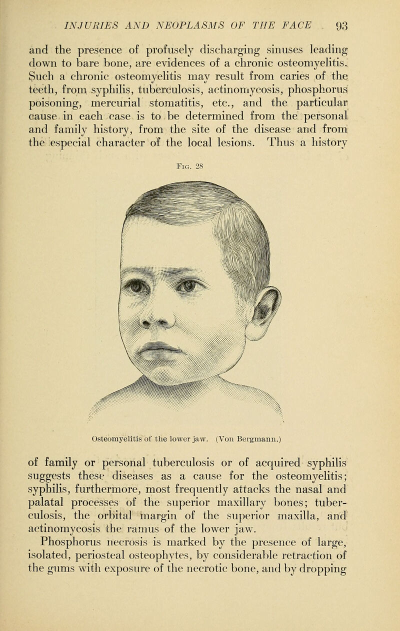 and the presence of profusely discharging sinuses leading down to bare bone, are evidences of a chronic osteomyelitis. Such a chronic osteomyelitis may result from caries of the teeth, from syphilis, tuberculosis, actinomycosis, phosphorus poisoning, mercurial stomatitis, etc., and the particular cause in each case is to be determined from the personal and family history, from the site of the disease and from the especial character of the local lesions. Thus a history Fig. 28 Osteomyelitis of tlie lower jaw. (Von Bergmann.) of family or personal tuberculosis or of acquired syphilis suggests these diseases as a cause for the osteomyelitis; syphilis, furthermore, most frequently attacks the nasal and palatal processes of the superior maxillary bones; tuber- culosis, the orbital margin of the superior maxilla, and actinomycosis the ramus of the lower jaw. Phosphorus necrosis is marked by the presence of large, isolated, periosteal osteophytes, by considerable retraction of the gums with exposure of the necrotic bone, and by dropping