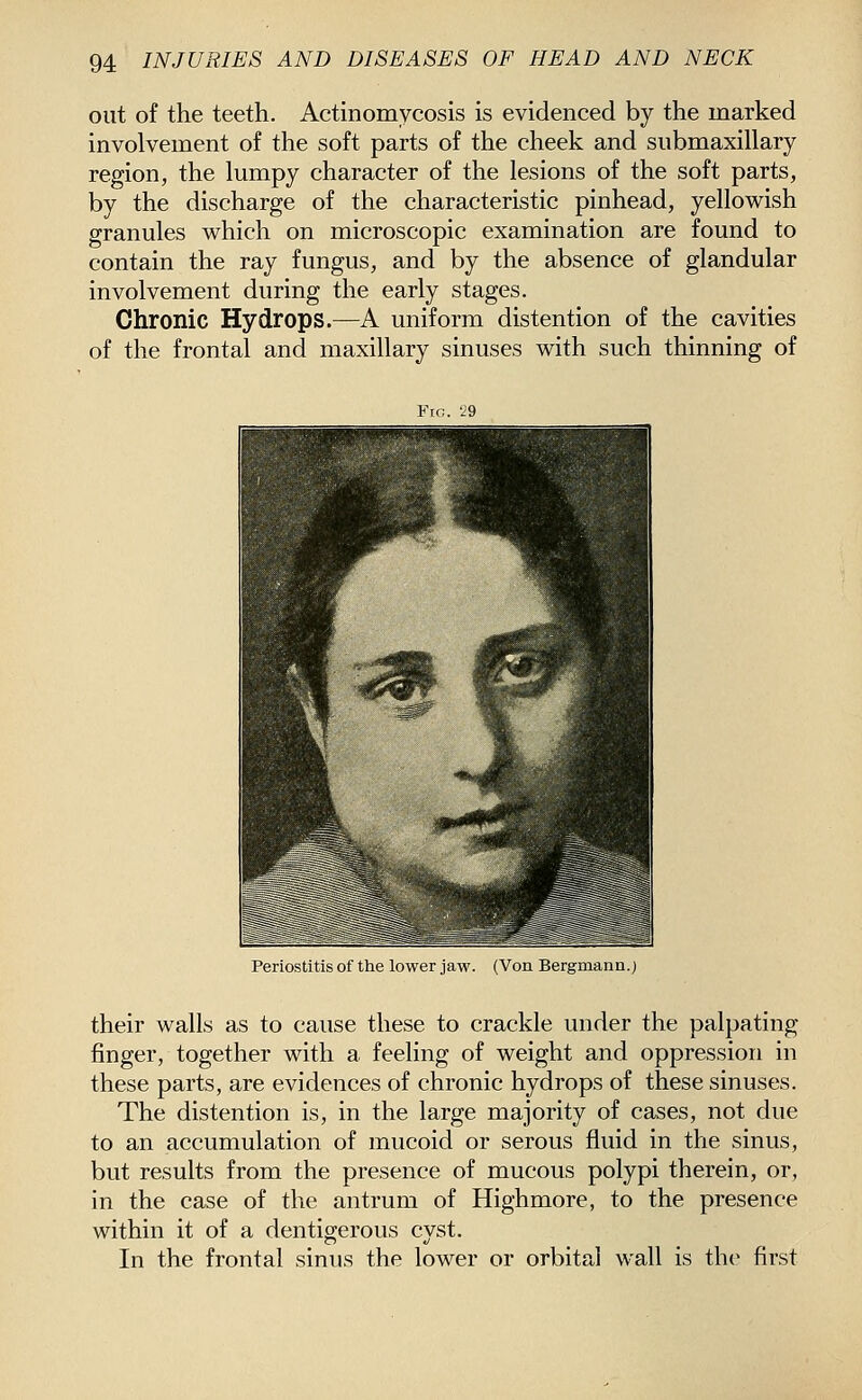 out of the teeth. Actinomycosis is evidenced by the marked involvement of the soft parts of the cheek and submaxillary region, the lumpy character of the lesions of the soft parts, by the discharge of the characteristic pinhead, yellowish granules which on microscopic examination are found to contain the ray fungus, and by the absence of glandular involvement during the early stages. Chronic Hydrops.—A uniform distention of the cavities of the frontal and maxillary sinuses with such thinning of Periostitis of the lower jaw. (Von Bergmann.) their walls as to cause these to crackle under the palpating finger, together with a feeling of weight and oppression in these parts, are evidences of chronic hydrops of these sinuses. The distention is, in the large majority of cases, not due to an accumulation of mucoid or serous fluid in the sinus, but results from the presence of mucous polypi therein, or, in the case of the antrum of Highmore, to the presence within it of a dentigerous cyst. In the frontal sinus the lower or orbital wall is the first