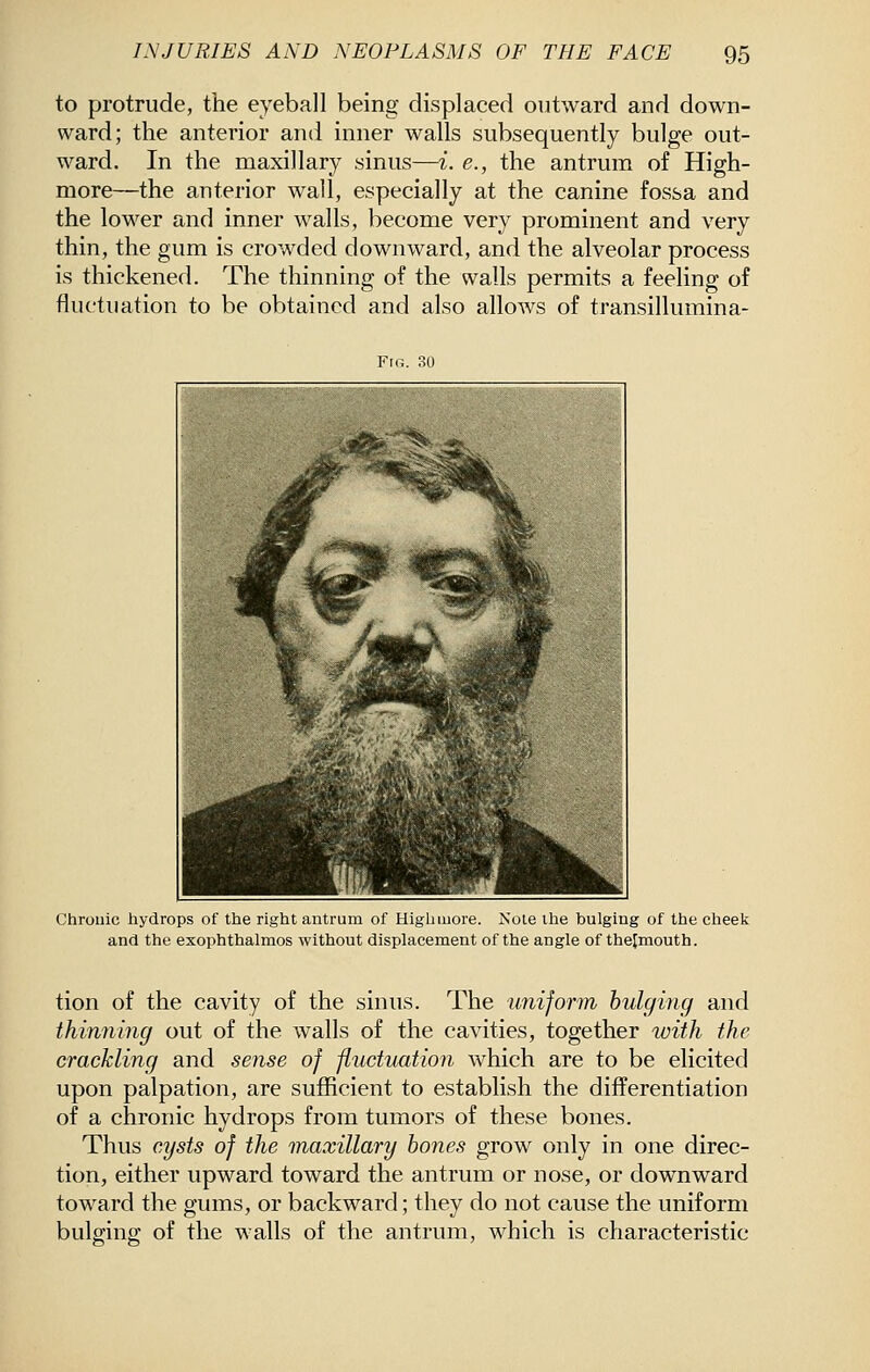 to protrude, the eyeball being displaced outward and down- ward; the anterior and inner walls subsequently bulge out- ward. In the maxillary sinus—i. e., the antrum of High- more—the anterior wall, especially at the canine fossa and the lower and inner walls, become very prominent and very thin, the gum is crowded downward, and the alveolar process is thickened. The thinning of the walls permits a feeling of fluctuation to be obtained and also allows of transillumina- FtG. 30 Chrouic hydrops of the right antrum of Higbmore. Note the bulging of the cheelc and the exophthalmos without displacement of the angle of thejmouth. tion of the cavity of the sinus. The unijorm bulging and thinning out of the walls of the cavities, together with the crackling and sense of fluctuation which are to be elicited upon palpation, are sufficient to establish the differentiation of a chronic hydrops from tumors of these bones. Thus cysts of the maxillary bones grow only in one direc- tion, either upward toward the antrum or nose, or downward toward the gums, or backward; they do not cause the uniform bulging of the walls of the antrum, which is characteristic