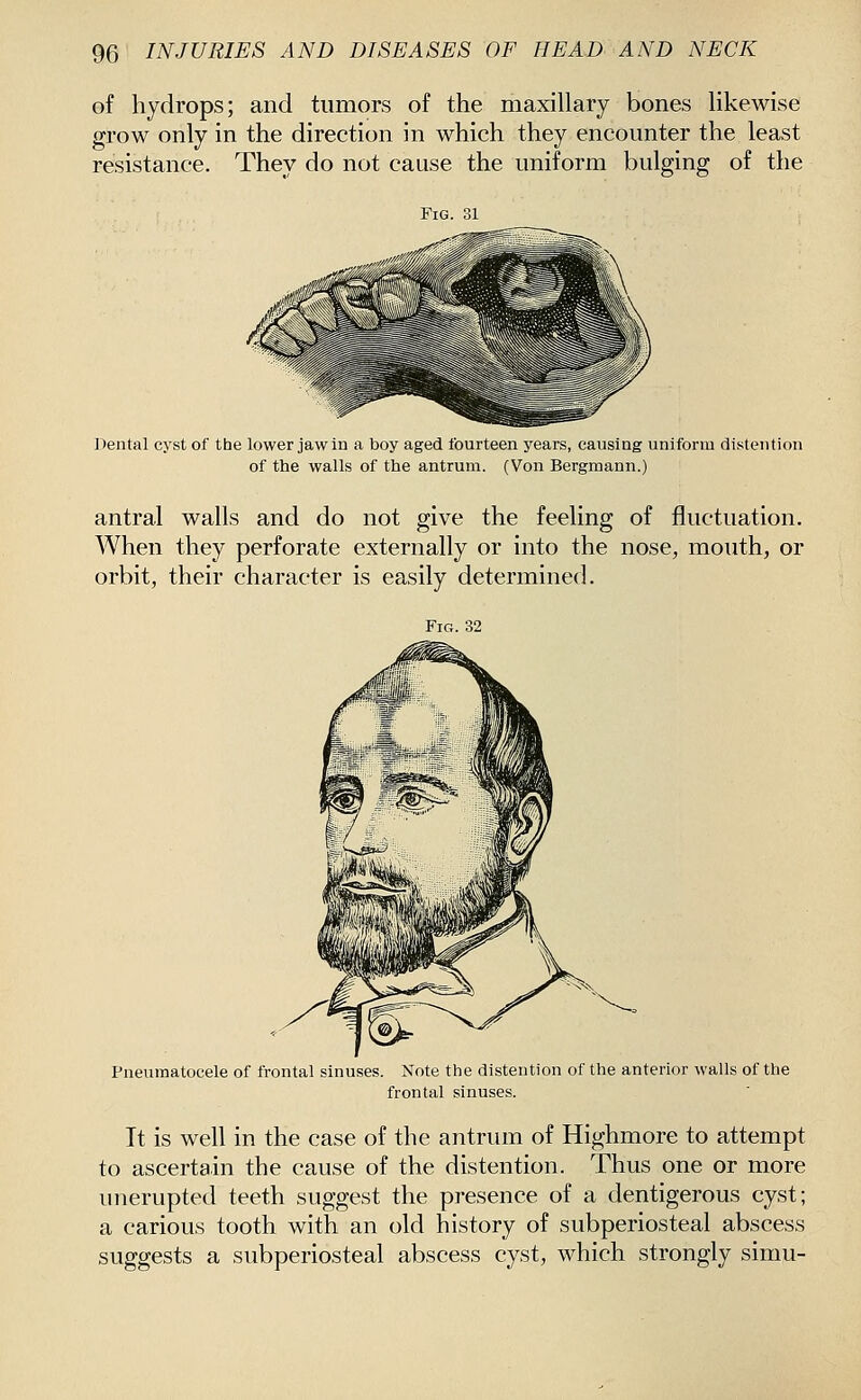 of hydrops; and tumors of the maxillary bones likewise grow only in the direction in which they encounter the least resistance. They do not cause the uniform bulging of the Fig. 31 Dental cyst of the lower jaw in a boy aged fourteen years, causing uniform distention of the walls of the antrum. (Von Bergmann.) antral walls and do not give the feeling of fluctuation. When they perforate externally or into the nose, mouth, or orbit, their character is easily determined. Fig. 32 Pneumatocele of frontal sinuses. Note the distention of the anterior walls of the frontal sinuses. It is well in the case of the antrum of Highmore to attempt to ascertain the cause of the distention. Thus one or more unerupted teeth suggest the presence of a dentigerous cyst; a carious tooth with an old history of subperiosteal abscess suggests a subperiosteal abscess cyst, which strongly simu-