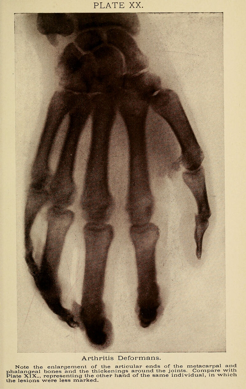 Arthritis Deformans. Note the enlargement of the artieu-lar ends of the metacarpal and phalangeal bones and the thickenings around the joints. Compare with Plate XIX., representing the other hand of the same individual, in which the lesions were less marked.