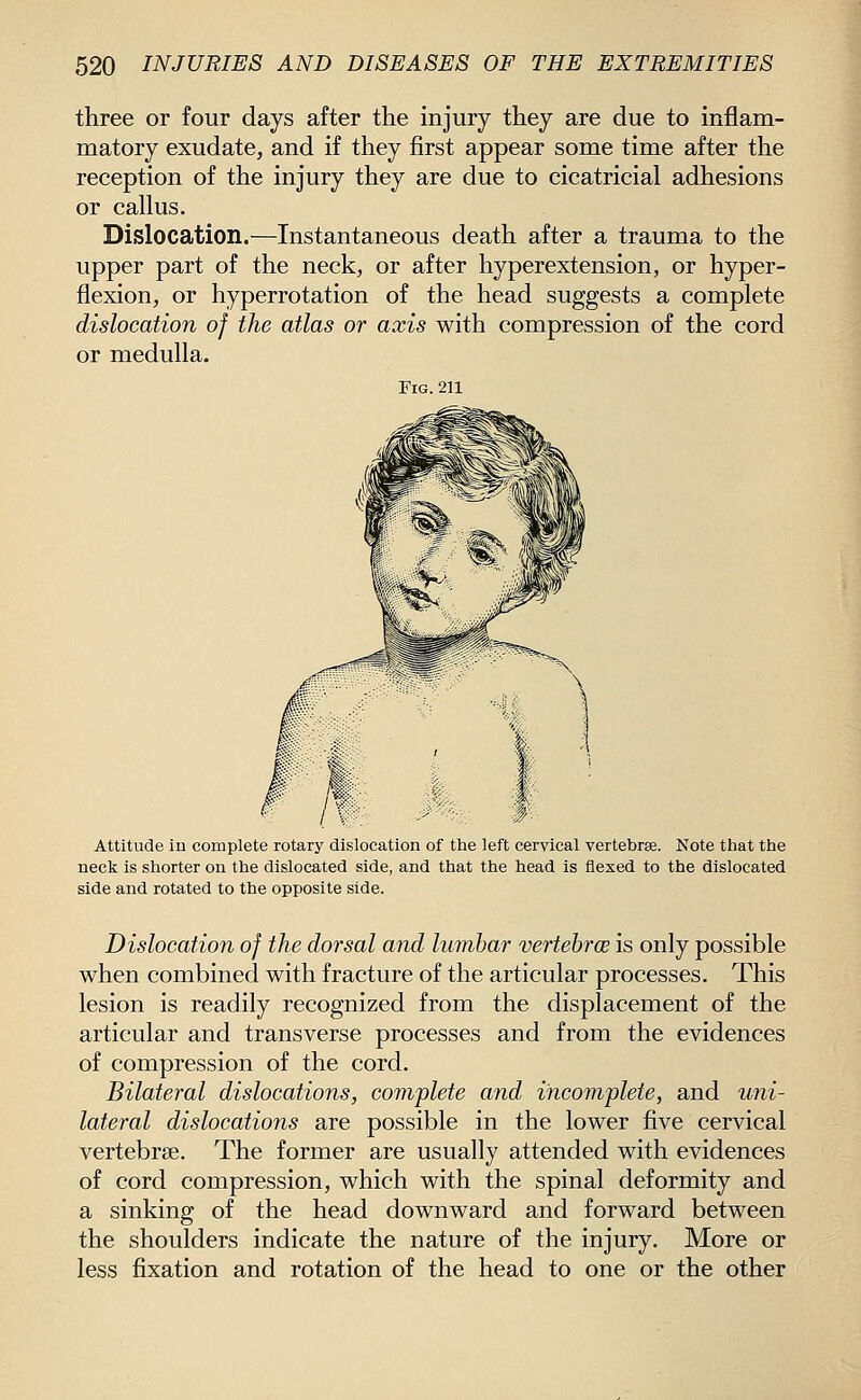 three or four days after the injury they are due to inflam- matory exudate, and if they first appear some time after the reception of the injury they are due to cicatricial adhesions or callus. Dislocation.—Instantaneous death after a trauma to the upper part of the neck, or after hyperextension, or hyper- flexion, or hyperrotation of the head suggests a complete dislocation of the atlas or axis with compression of the cord or medulla. Fig. 211 Attitude in complete rotary dislocation of the left cervical vertebrae. Note that the neck is shorter on the dislocated side, and that the head is flexed to the dislocated side and rotated to the opposite side. Dislocation of the dorsal and lumbar vertebrae is only possible when combined with fracture of the articular processes. This lesion is readily recognized from the displacement of the articular and transverse processes and from the evidences of compression of the cord. Bilateral dislocations, complete and incomplete, and uni- lateral dislocations are possible in the lower five cervical vertebrae. The former are usually attended with evidences of cord compression, which with the spinal deformity and a sinking of the head downward and forward between the shoulders indicate the nature of the injury. More or less fixation and rotation of the head to one or the other