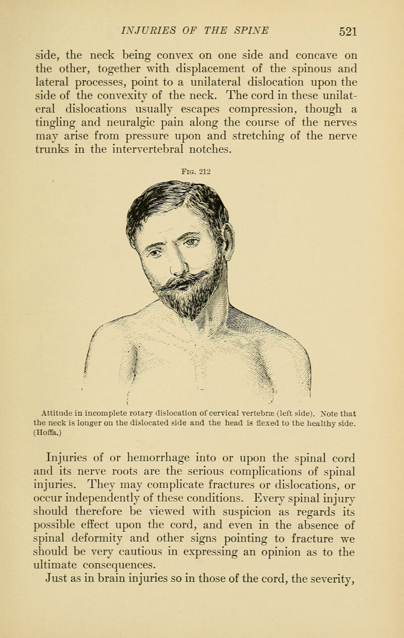 side, the neck being convex on one side and concave on the other, together with displacement of the spinous and lateral processes, point to a unilateral dislocation upon the side of the convexity of the neck. The cord in these unilat- eral dislocations usually escapes compression, though a tingling and neuralgic pain along the course of the nerves may arise from pressure upon and stretching of the nerve trunks in the intervertebral notches. Fig. 212 1. Attitude in incomplete rotary dislocation of cervical vertebra (left side). Note that the neck is longer on the dislocated side and the head is flexed to the healthy side. (Hoffa.) Injuries of or hemorrhage into or upon the spinal cord and its nerve roots are the serious complications of spinal injuries. They may complicate fractures or dislocations, or occur independently of these conditions. Every spinal mjury should therefore be ^-iewed with suspicion as regards its possible effect upon the cord, and even in the absence of spinal deformity and other signs pointing to fracture we should be very cautious in expressing an opinion as to the ultimate consec|uences. Just as in brain injuries so in those of the cord, the severity.