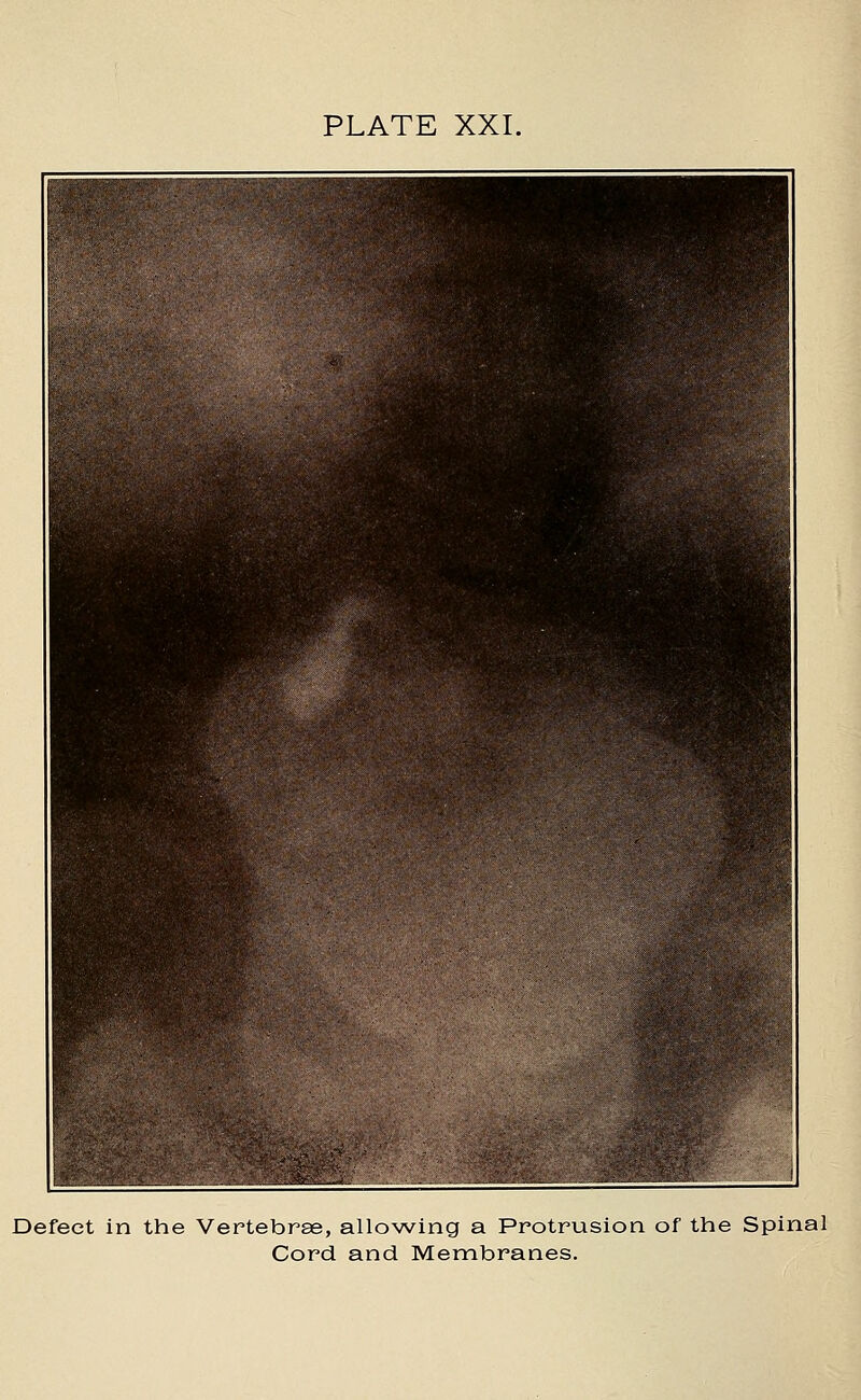 PLATE XXI. Defect in the Vertebrae, allowing a Protrusion of the Spinal Cord and Membranes.