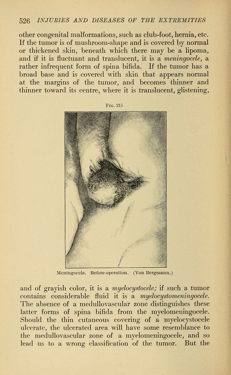other congenital malformations, such as club-foot, hernia, etc. If the tumor is of mushroom-shape and is covered by normal or thickened skin, beneath which there may be a lipoma, and if it is fluctuant and translucent, it is a meningocele, a rather infrequent form of spina bifida. If the tumor has a broad base and is covered with skin that appears normal at the margins of the tumor, and becomes thinner and thinner toward its centre, where it is translucent, glistening, Fig.215 Meningocele. Before operation. (Von Bergmann.) and of grayish color, it is a myelocystocele; if such a tumor contains considerable fluid it is a myelocystomeningocele. The absence of a medullovascular zone distinguishes these latter forms of spina bifida from the myelomeningocele. Should the thin cutaneous covering of a myelocystocele ulcerate, the ulcerated area will have some resemblance to the medullovascular zone of a myelomeningocele, and so lead us to a wrong classification of the tumor. But the