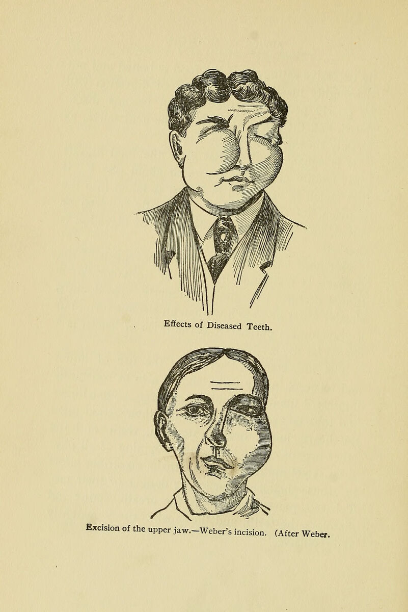 Effects of Diseased Teeth. Excision of the upper jaw.—Weber' s incision. (After Weber.