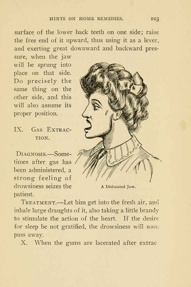 surface of the lower back teeth on one side; raise the free end of it upward, thus using it as a lever, and exerting- great downward and backward pres- sure, when the jaw will be sprung into place on that side. Do precisely the same thing on the other side, and this will also assume its proper position. IX. Gas Extrac- tion. Diagnosis.—Some- ^ times after gas has been administered, a strong feeling of drowsiness seizes the a Dislocated jaw. patient. Treatment.—Let him get into the fresh air, and inhale large draughts of it, also taking a little brandy to stimulate the action of the heart. If the desire for sleep be not gratified, the drowsiness will soon pass away. X. When the gums are lacerated after extrac