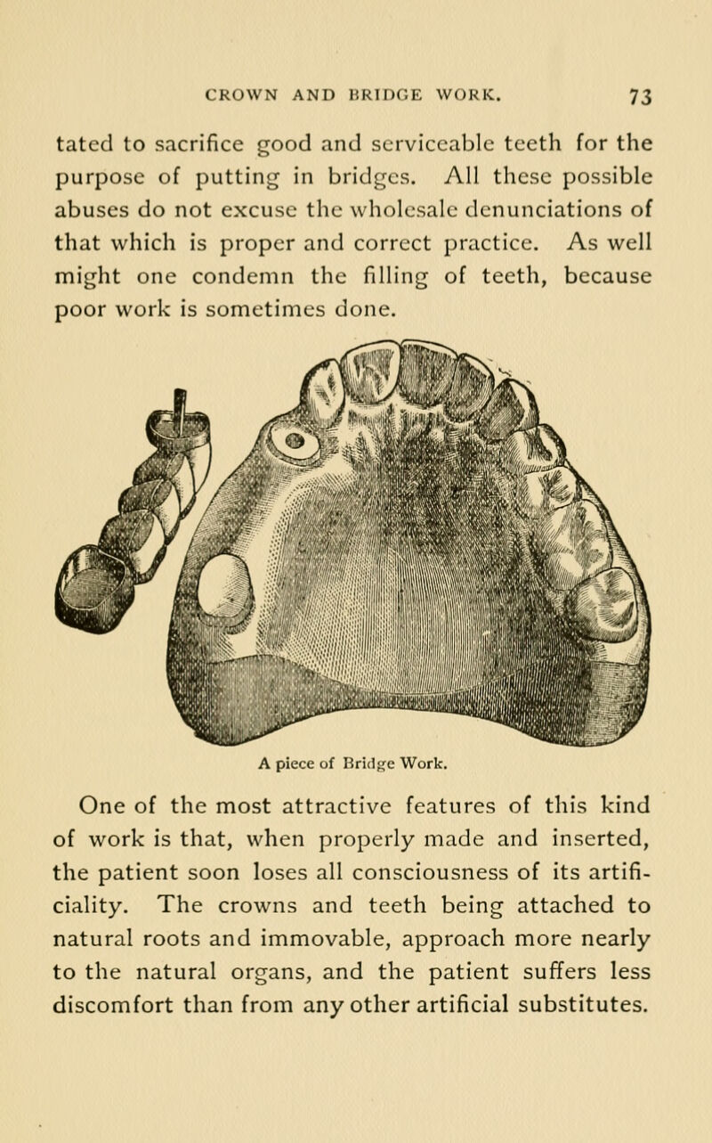tated to sacrifice good and serviceable teeth for the purpose of putting in bridges. All these possible abuses do not excuse the wholesale denunciations of that which is proper and correct practice. As well might one condemn the filling of teeth, because poor work is sometimes done. A piece of Bridge Work. One of the most attractive features of this kind of work is that, when properly made and inserted, the patient soon loses all consciousness of its artifi- ciality. The crowns and teeth being attached to natural roots and immovable, approach more nearly to the natural organs, and the patient suffers less discomfort than from any other artificial substitutes.