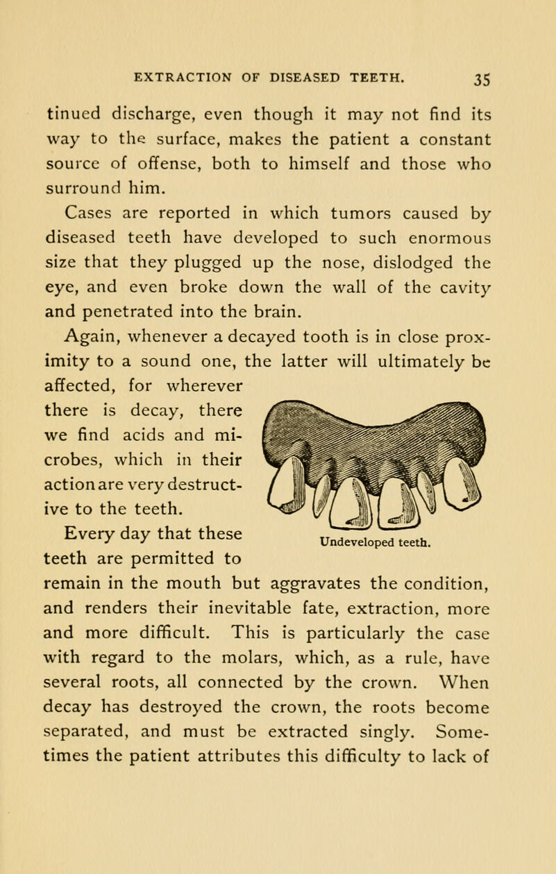 tinued discharge, even though it may not find its way to the surface, makes the patient a constant source of offense, both to himself and those who surround him. Cases are reported in which tumors caused by diseased teeth have developed to such enormous size that they plugged up the nose, dislodged the eye, and even broke down the wall of the cavity and penetrated into the brain. Again, whenever a decayed tooth is in close prox- imity to a sound one, the latter will ultimately be affected, for wherever there is decay, there we find acids and mi- crobes, which in their action are very destruct- ive to the teeth. Every day that these teeth are permitted to remain in the mouth but aggravates the condition, and renders their inevitable fate, extraction, more and more difficult. This is particularly the case with regard to the molars, which, as a rule, have several roots, all connected by the crown. When decay has destroyed the crown, the roots become separated, and must be extracted singly. Some- times the patient attributes this difficulty to lack of Undeveloped teeth.