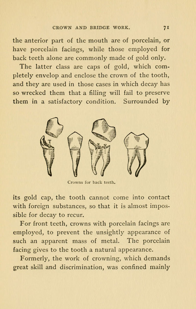 the anterior part of the mouth are of porcelain, or have porcelain facings, while those employed for back teeth alone are commonly made of gold only. The latter class are caps of gold, which com- pletely envelop and enclose the crown of the tooth, and they are used in those cases in which decay has so wrecked them that a filling will fail to preserve them in a satisfactory condition. Surrounded by Crowns for back teeth. its gold cap, the tooth cannot come into contact with foreign substances, so that it is almost impos- sible for decay to recur. For front teeth, crowns with porcelain facings are employed, to prevent the unsightly appearance of such an apparent mass of metal. The porcelain facing gives to the tooth a natural appearance. Formerly, the work of crowning, which demands great skill and discrimination, was confined mainly